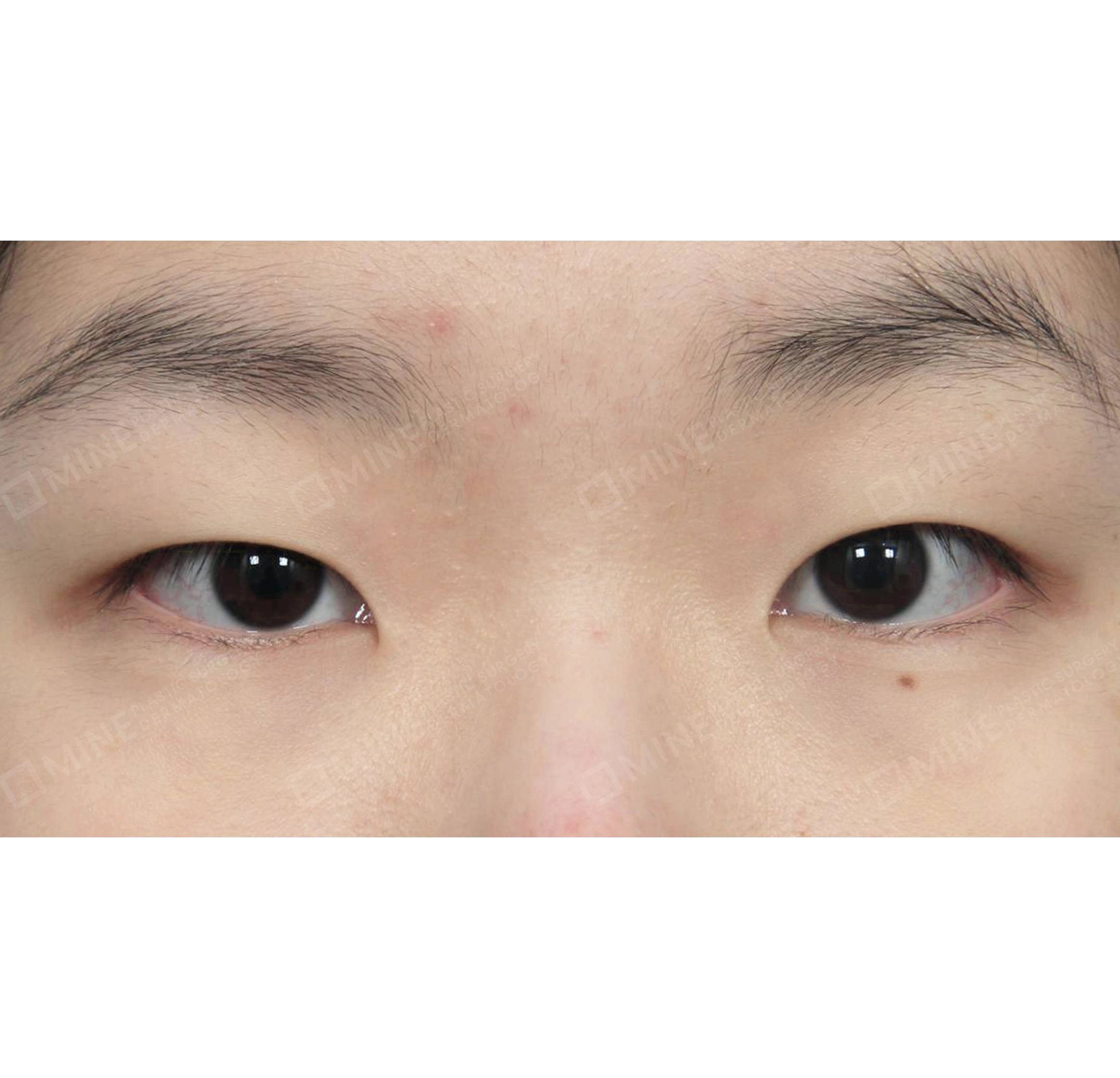 ปรับกล้ามเนื้อตา-ด้านหน้า-ก่อน