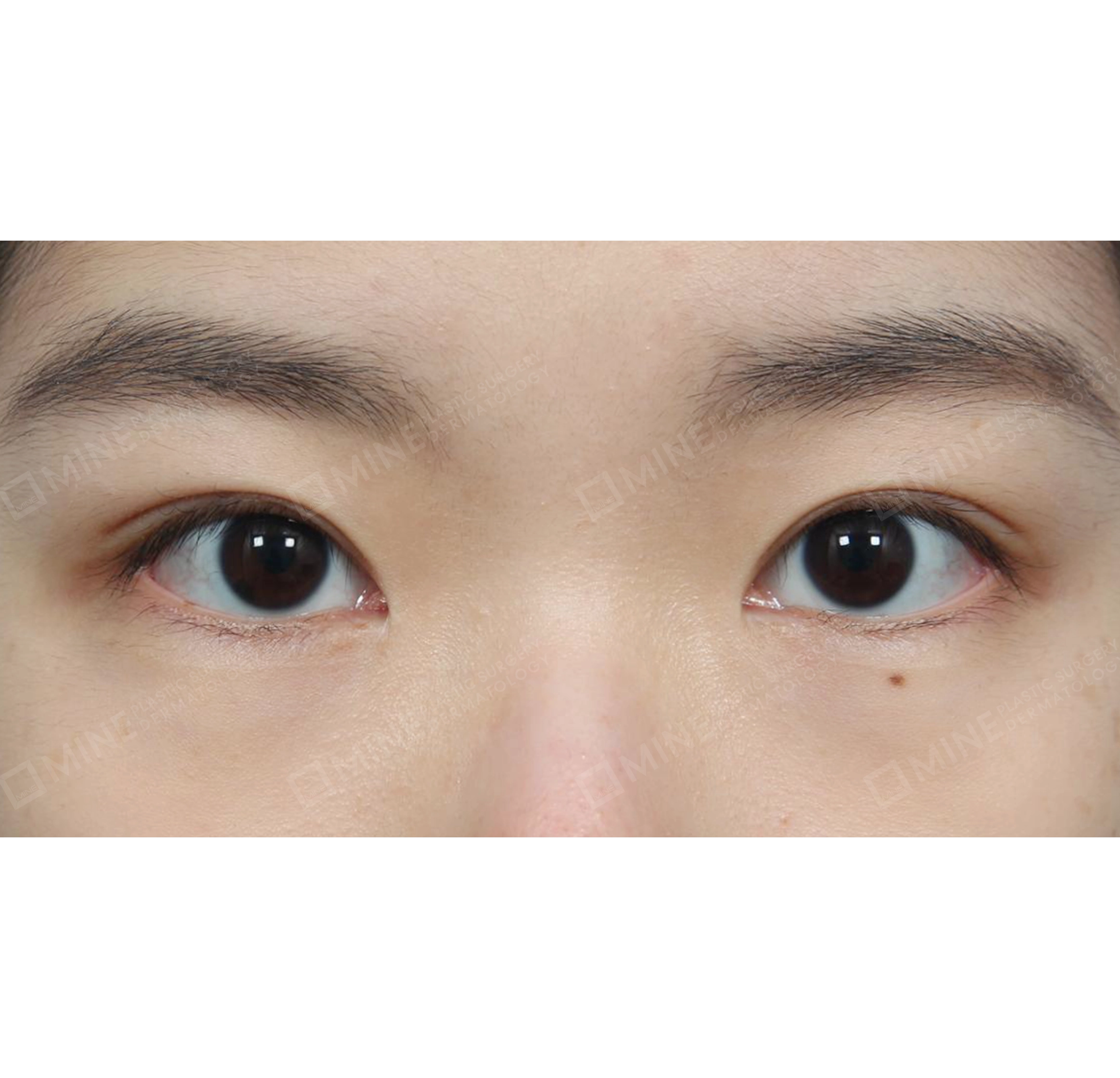 ปรับกล้ามเนื้อตา-ด้านหน้า-หลัง