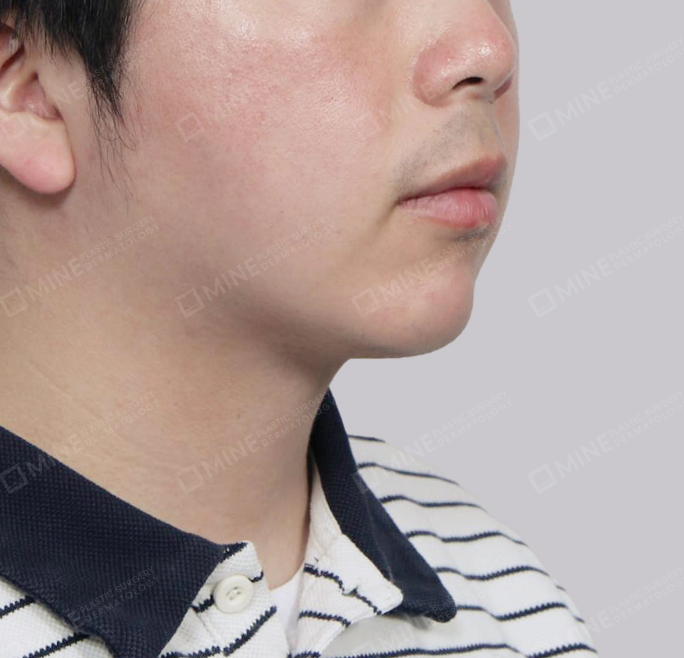 มัดกล้ามเนื้อคาง-ด้านหน้า-หลัง