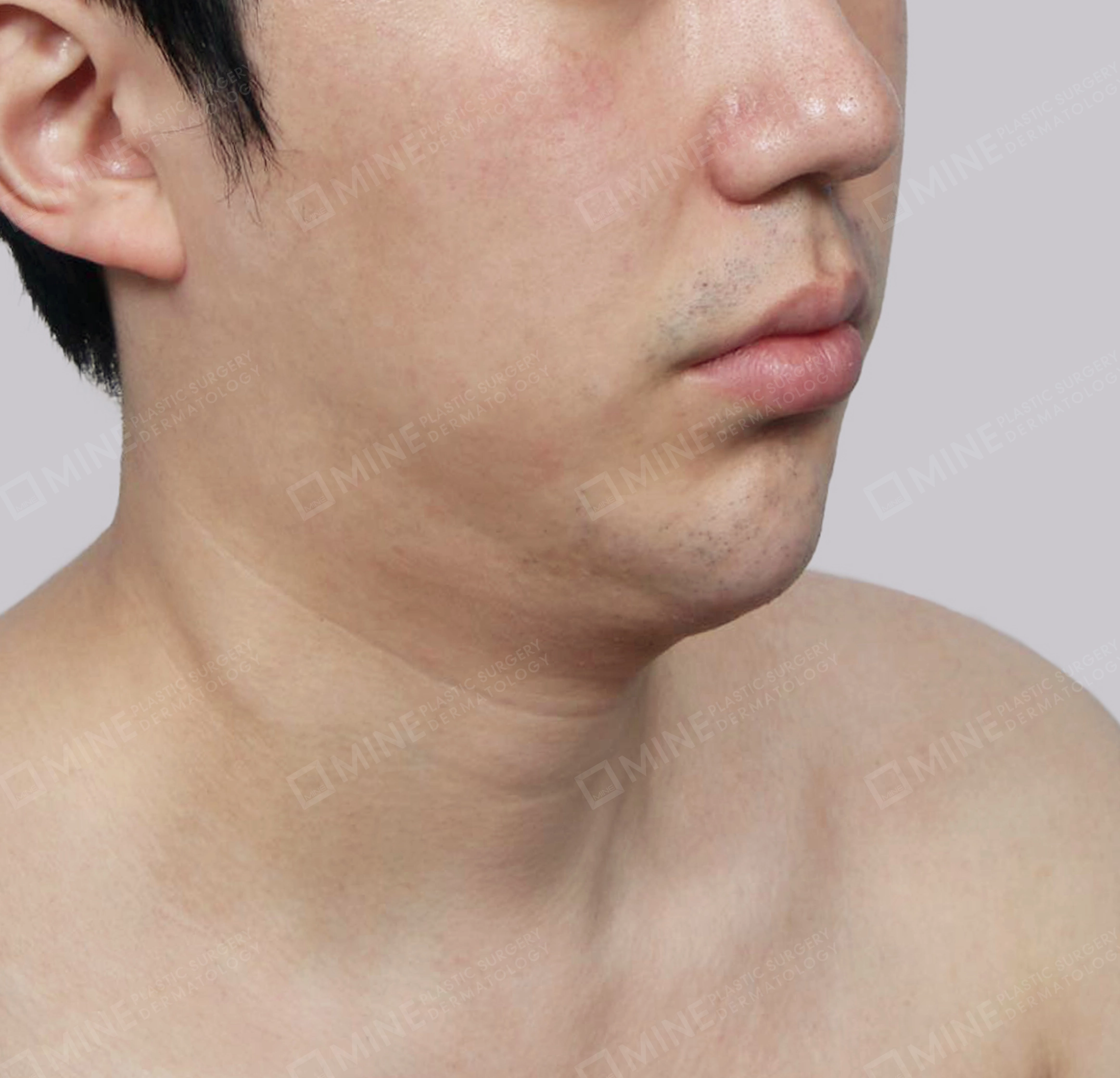 มัดกล้ามเนื้อคาง-ด้านหน้า-ก่อน