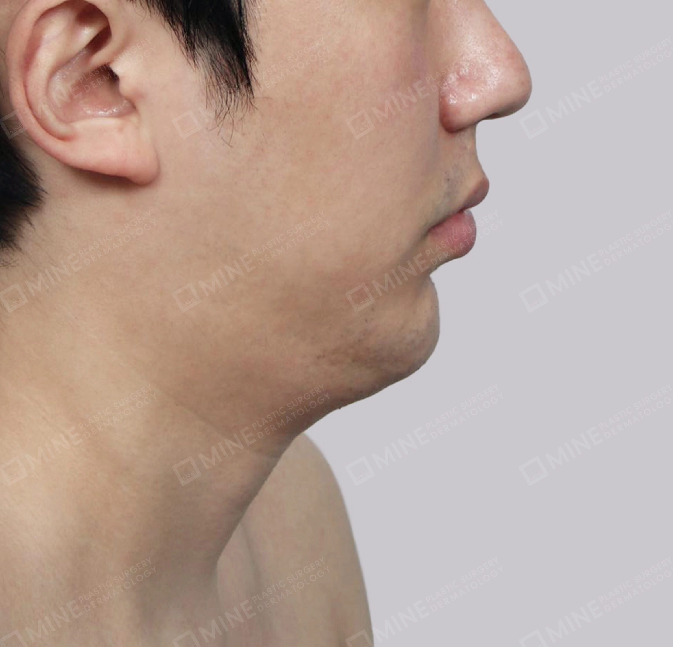 มัดกล้ามเนื้อคาง-ด้านข้าง-ก่อน