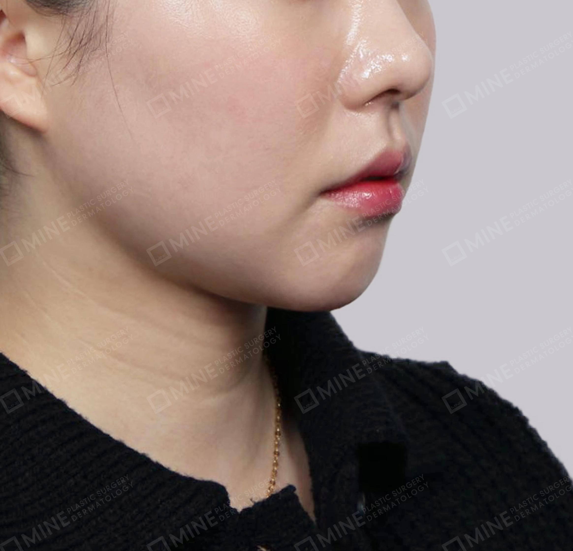 มัดกล้ามเนื้อคาง-ด้านหน้า-หลัง
