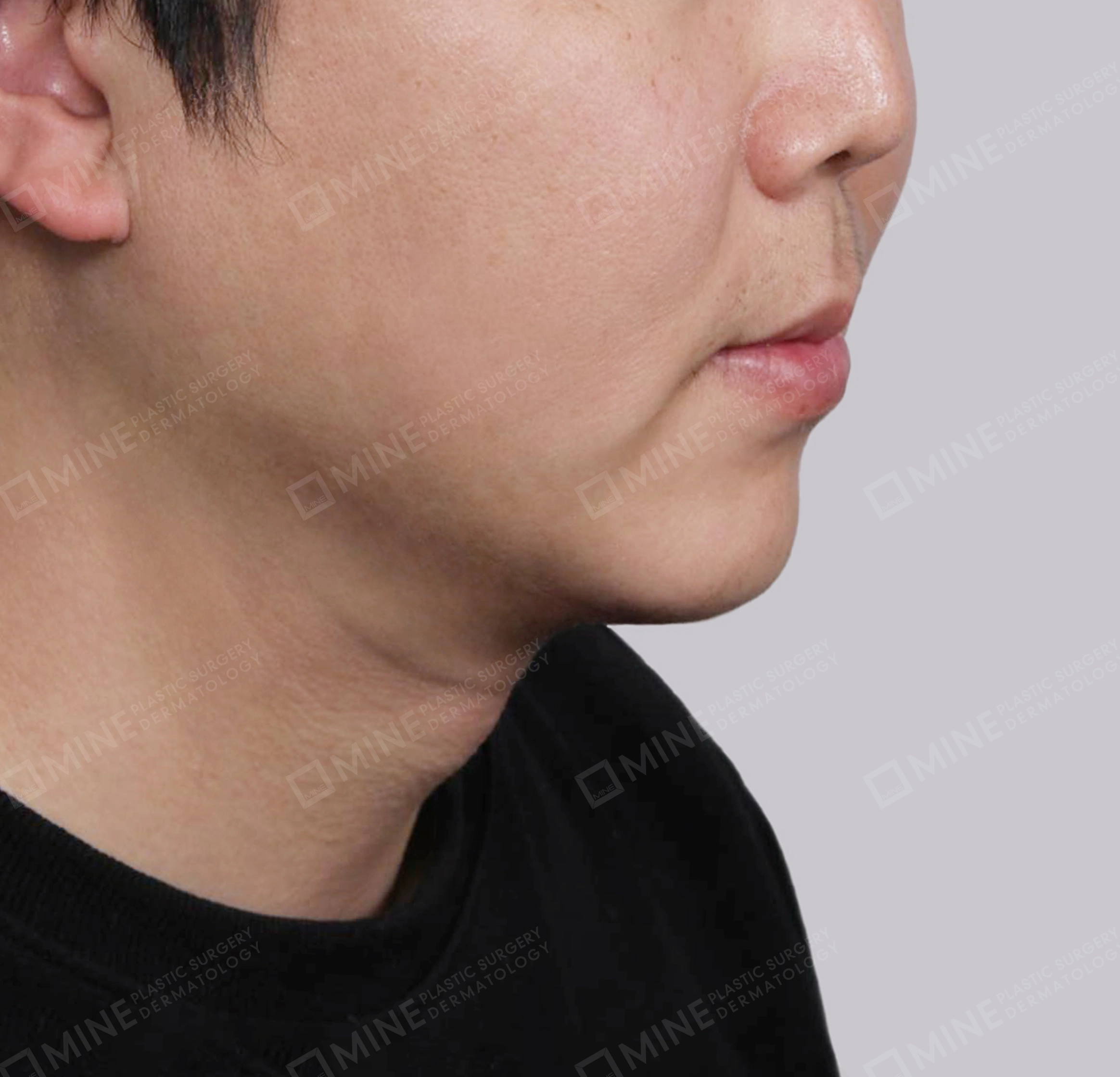 มินิลิฟติ้งคอ-ด้านหน้า-หลัง