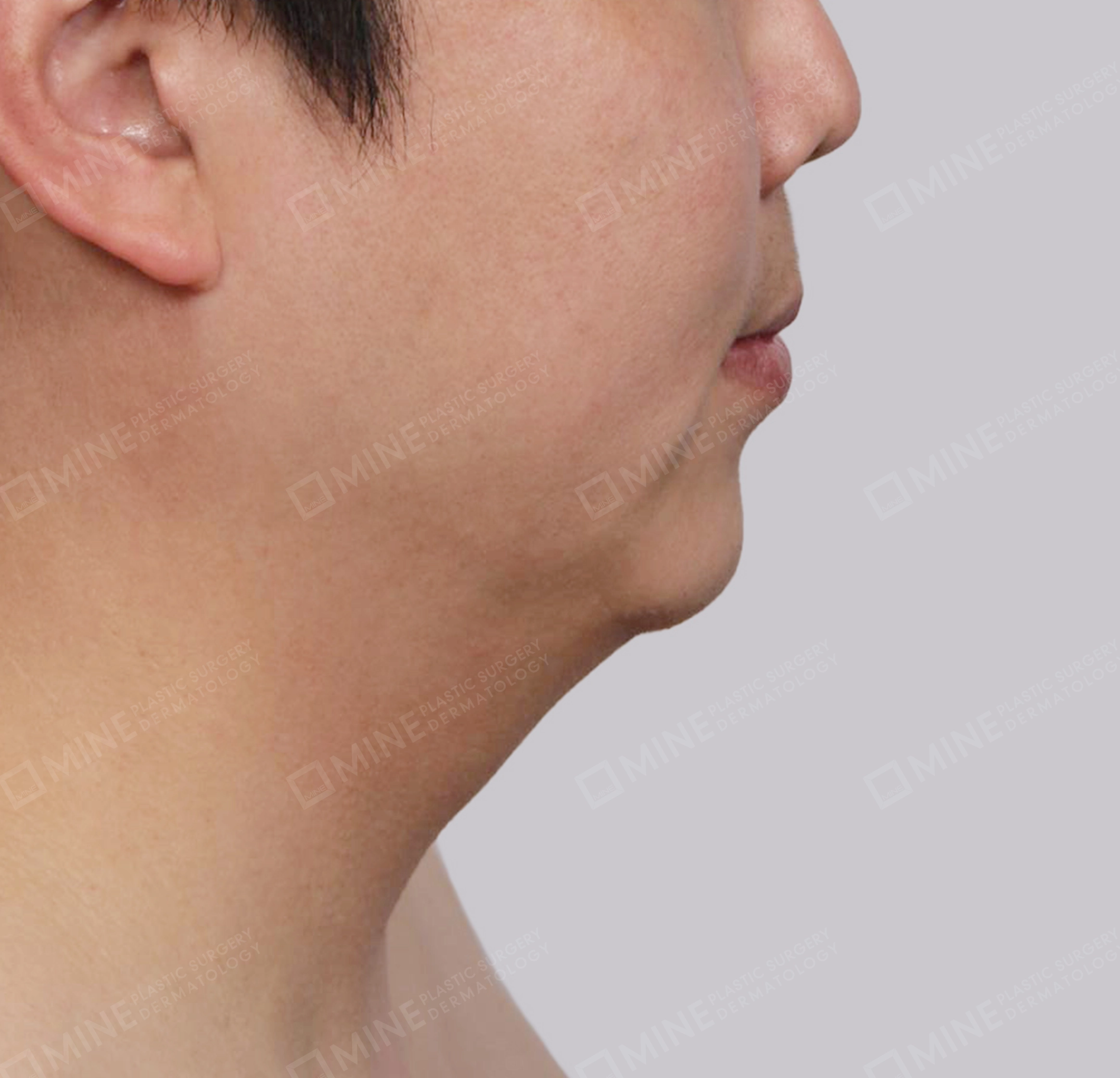 มินิลิฟติ้งคอ-ด้านข้าง-ก่อน