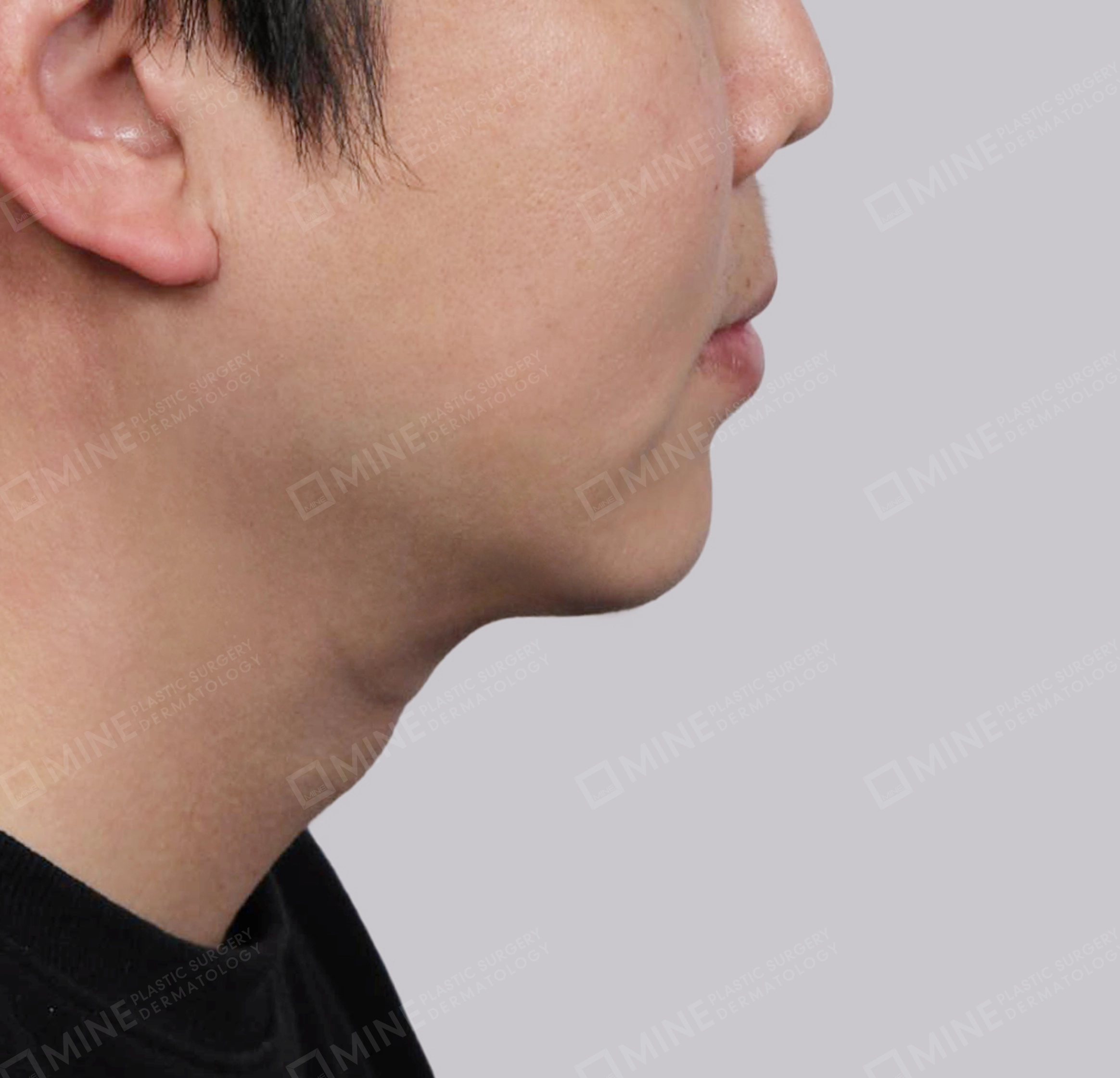 มินิลิฟติ้งคอ-ด้านข้าง-หลัง