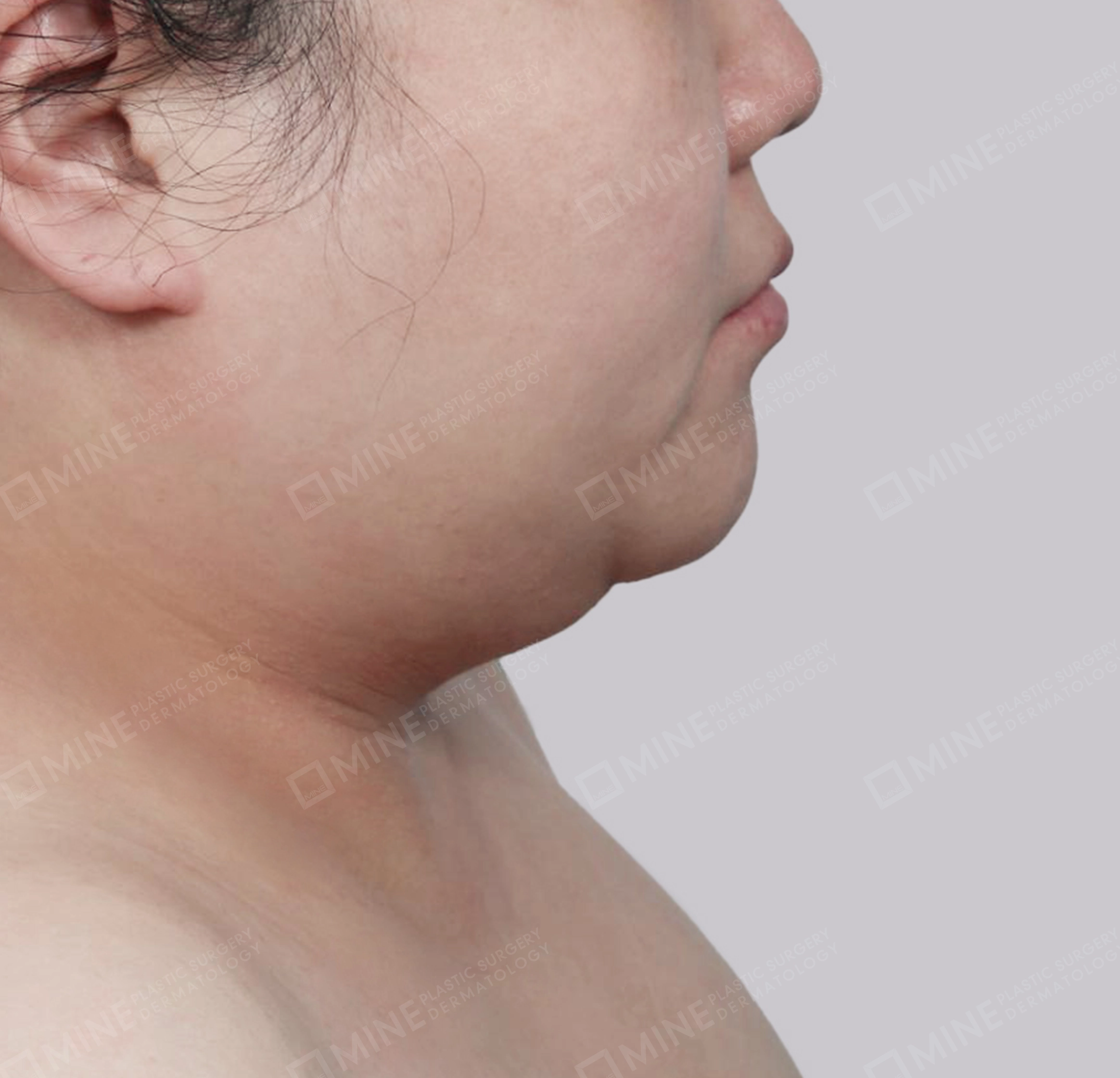 มินิลิฟติ้งคอ-ด้านข้าง-ก่อน