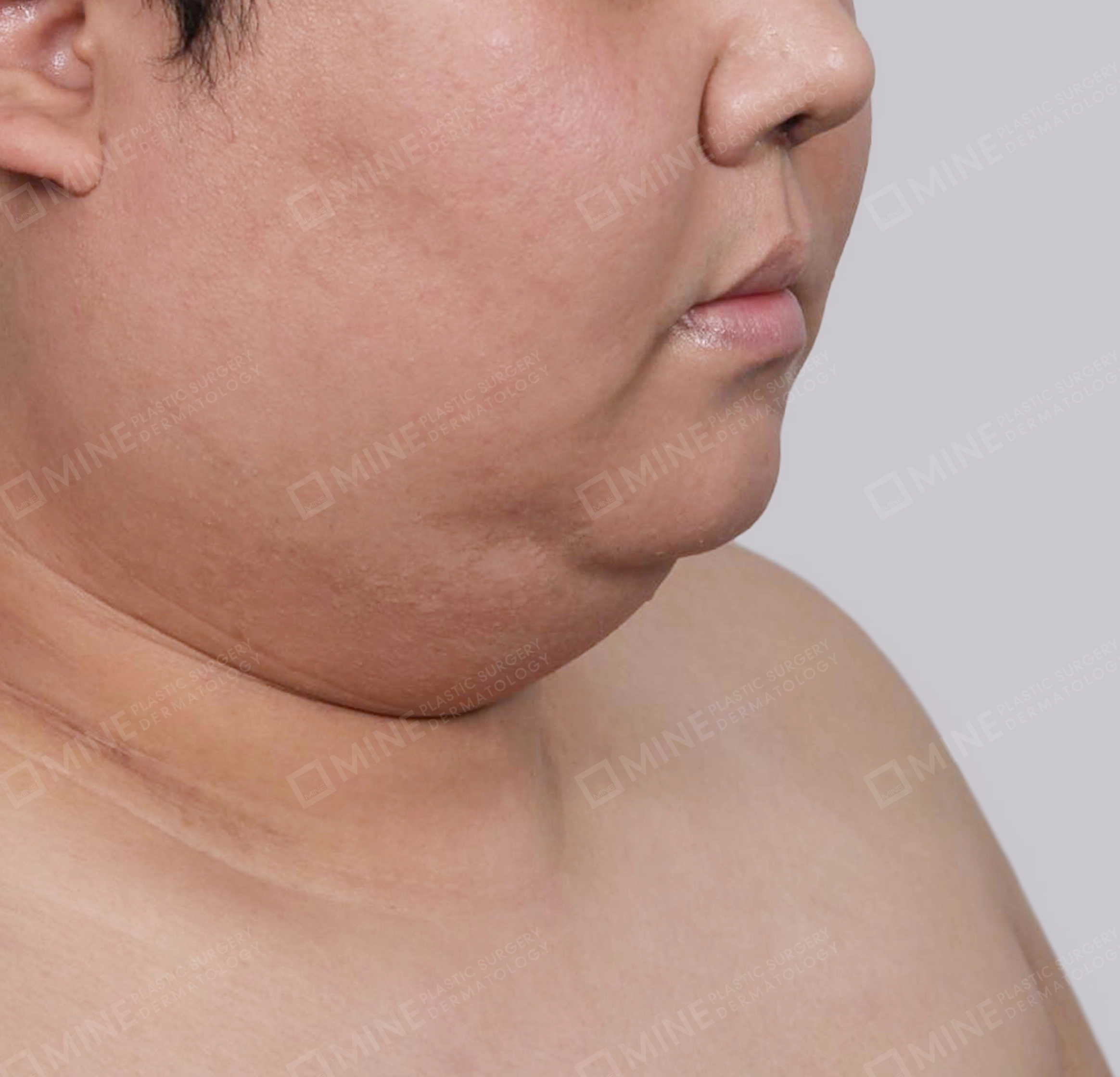 มินิลิฟติ้งคอ-ด้านหน้า-ก่อน