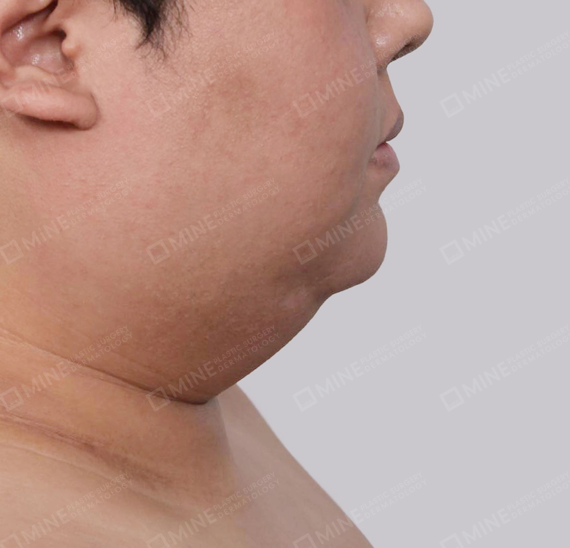 มินิลิฟติ้งคอ-ด้านข้าง-ก่อน