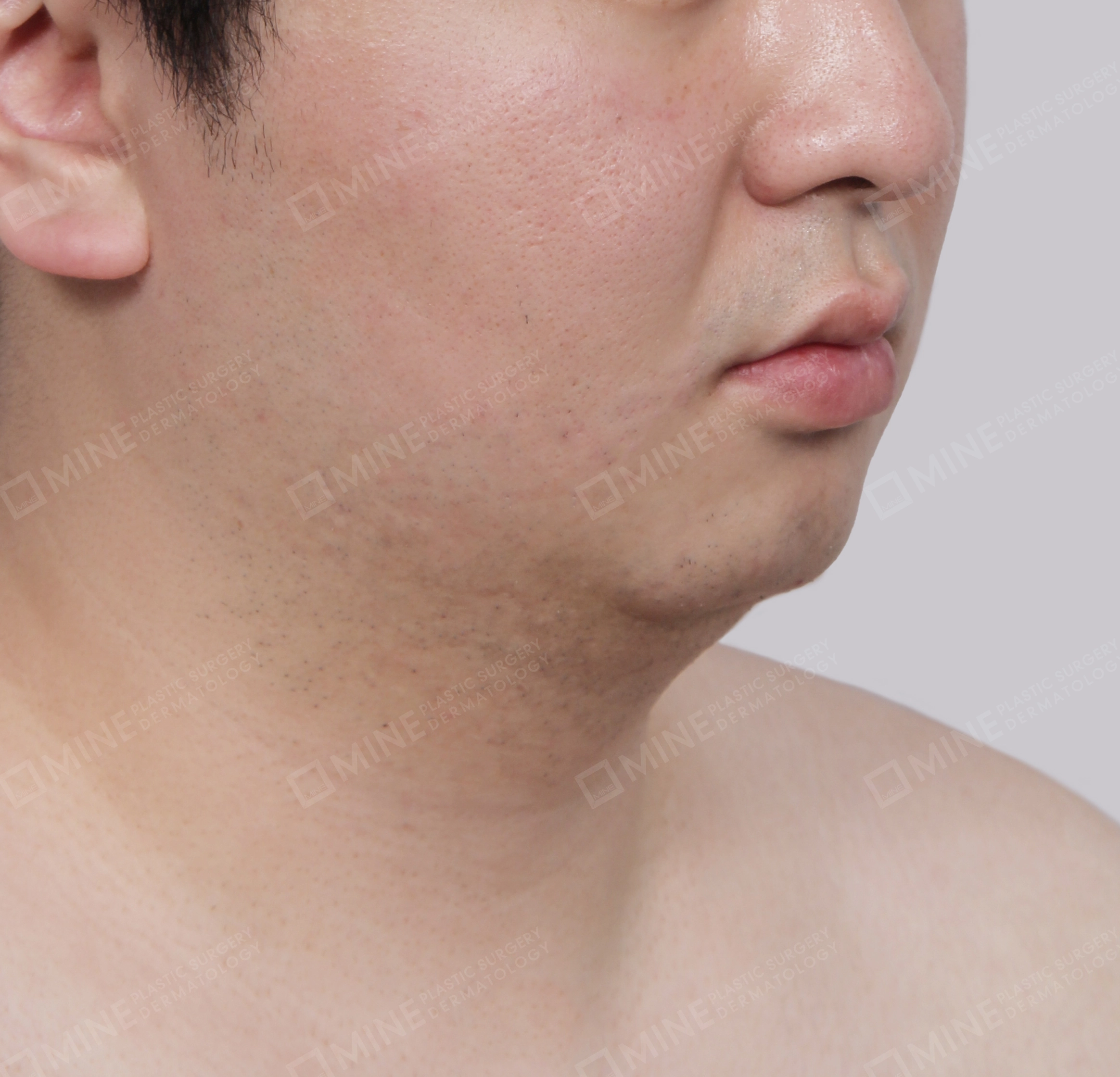 มินิลิฟติ้งคอ-ด้านหน้า-ก่อน