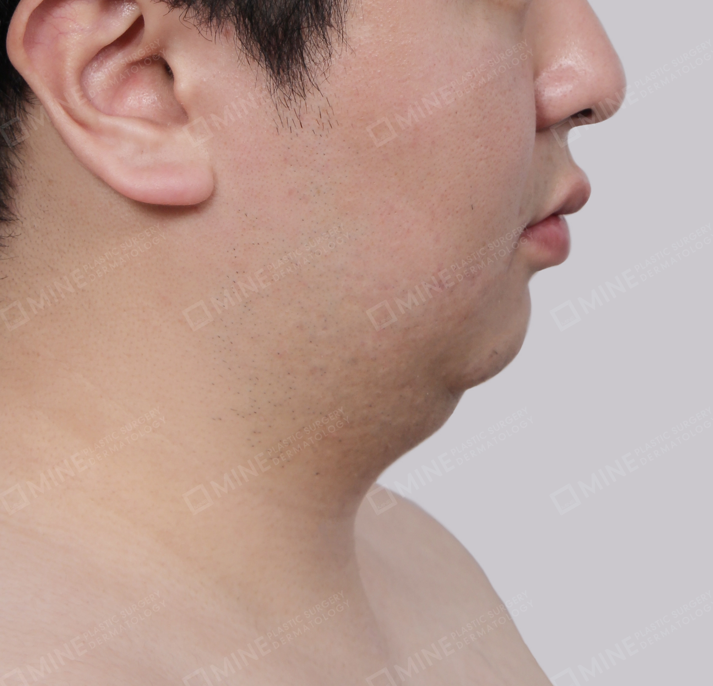 มินิลิฟติ้งคอ-ด้านข้าง-ก่อน
