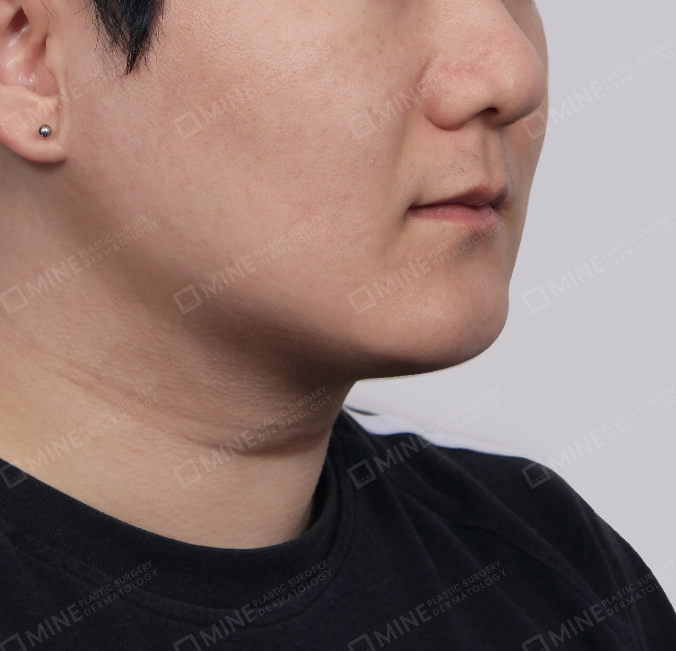 มินิลิฟติ้งคอ-ด้านหน้า-หลัง