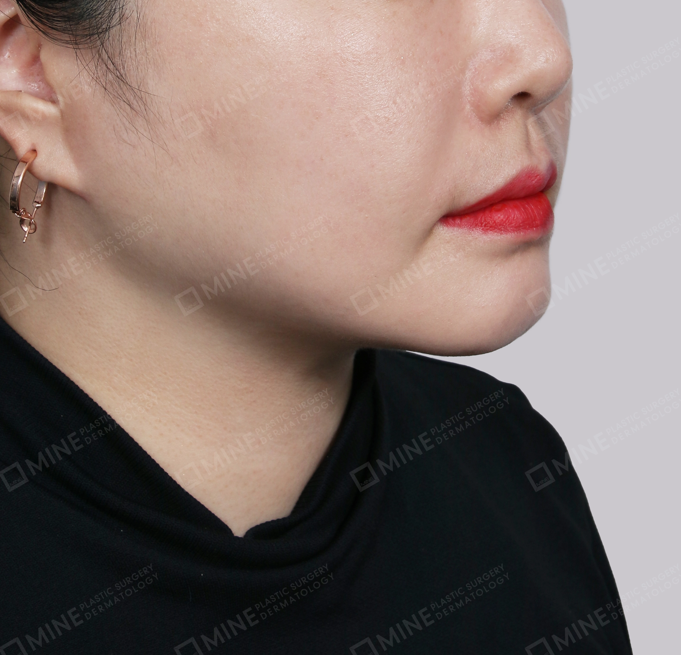 มินิลิฟติ้งคอ-ด้านหน้า-หลัง