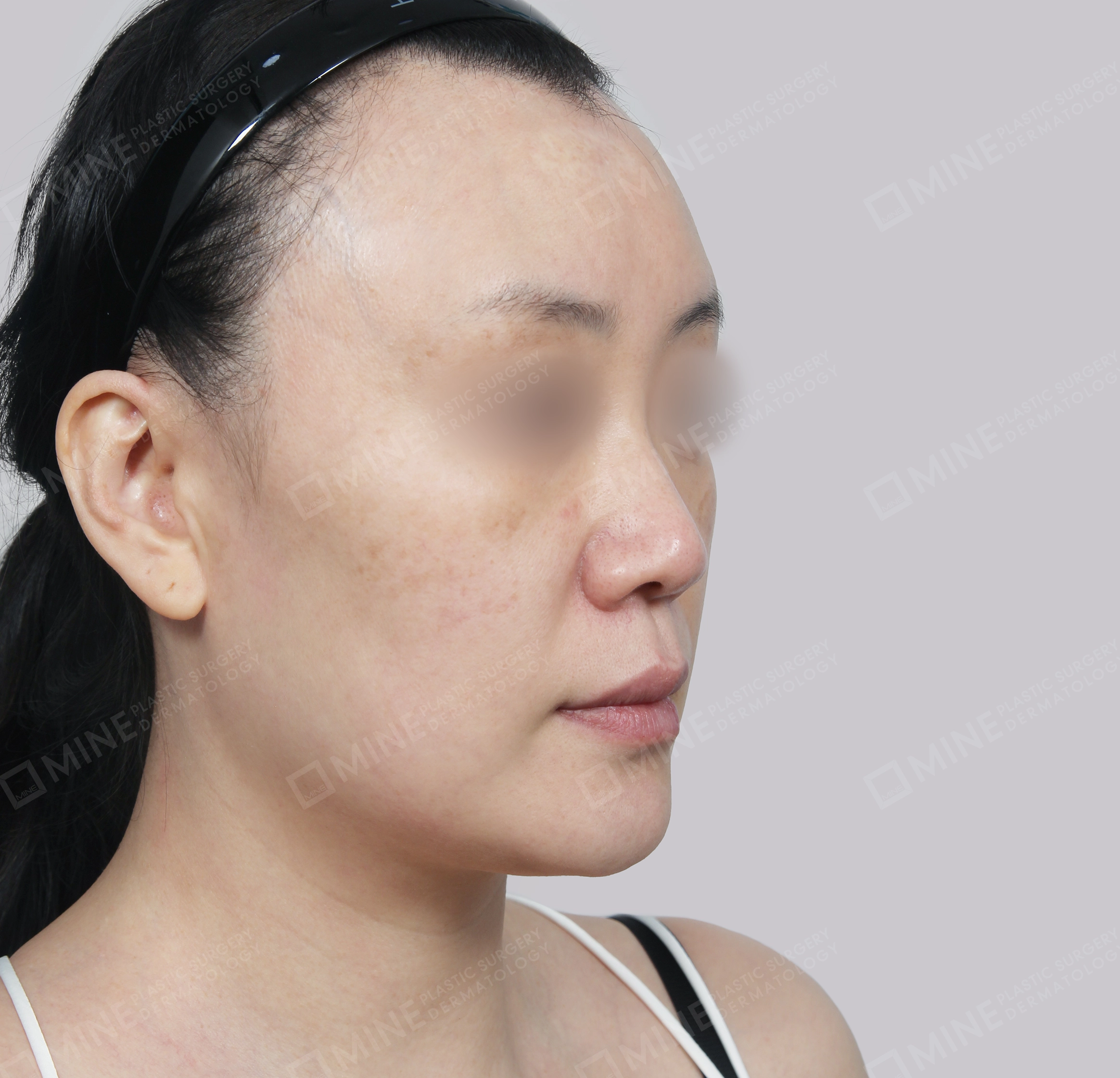 ยกกระชับหน้า-45 องศา-ก่อน