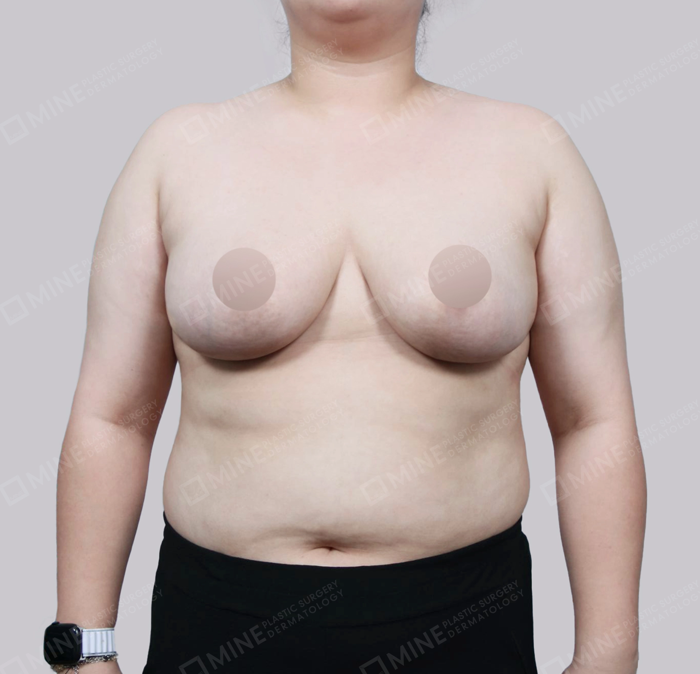ลดขนาดหน้าอก-ด้านหน้า-หลัง