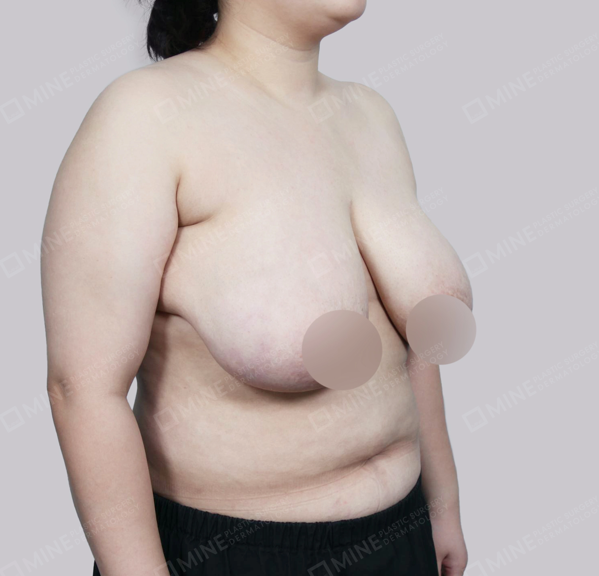 ลดขนาดหน้าอก-45 องศา-ก่อน