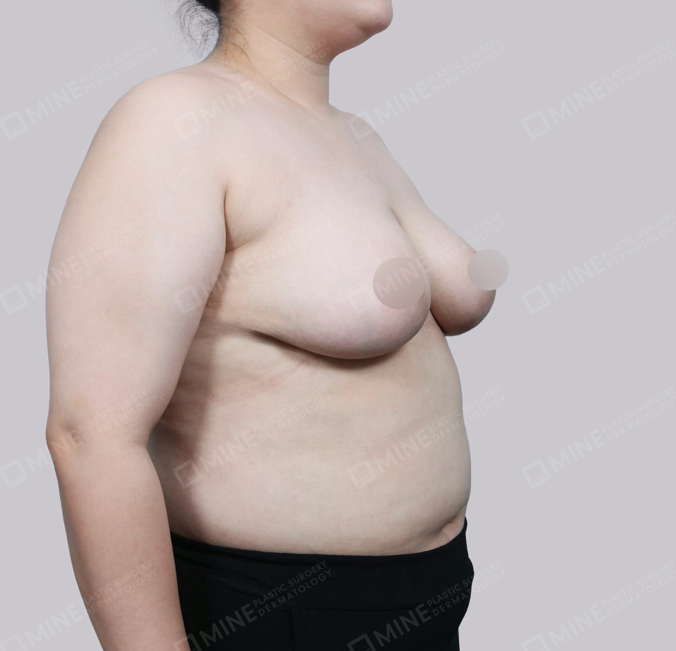 ลดขนาดหน้าอก-45 องศา-หลัง
