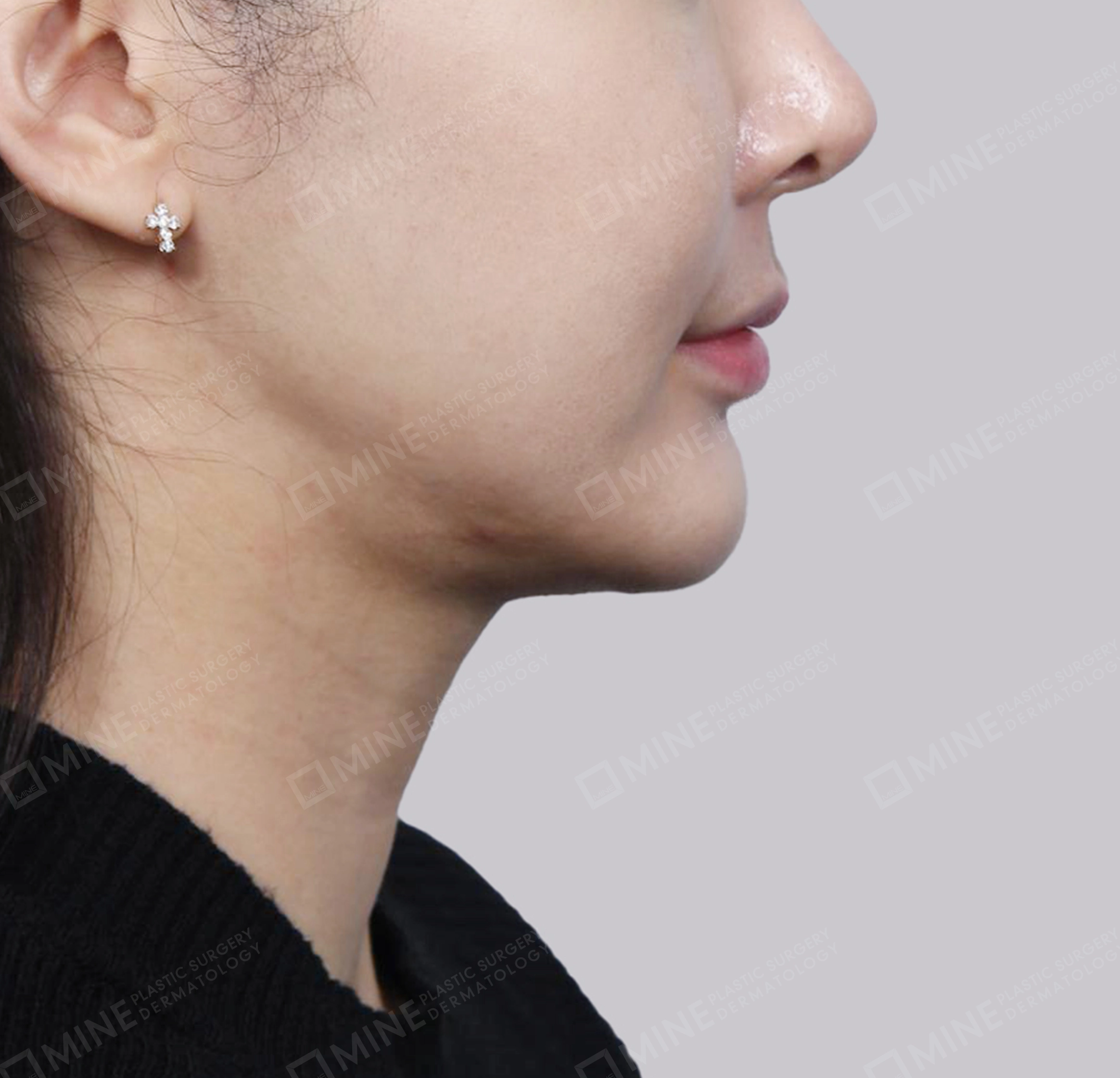 คางสองชั้น + การกำจัดต่อมน้ำลายใต้คาง-ด้านหน้า-ก่อน