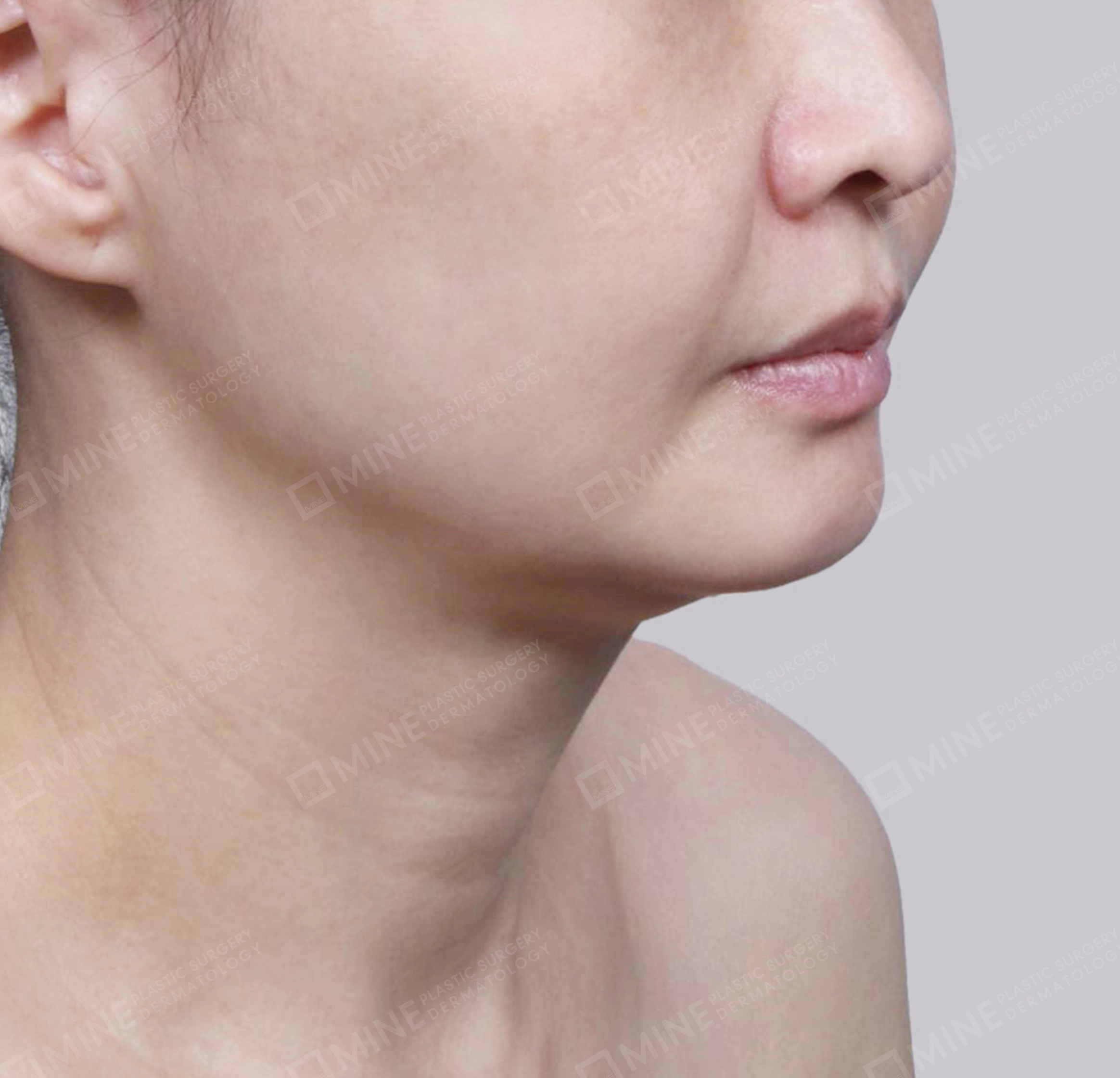 คางสองชั้น + การกำจัดต่อมน้ำลายใต้คาง-정면-전