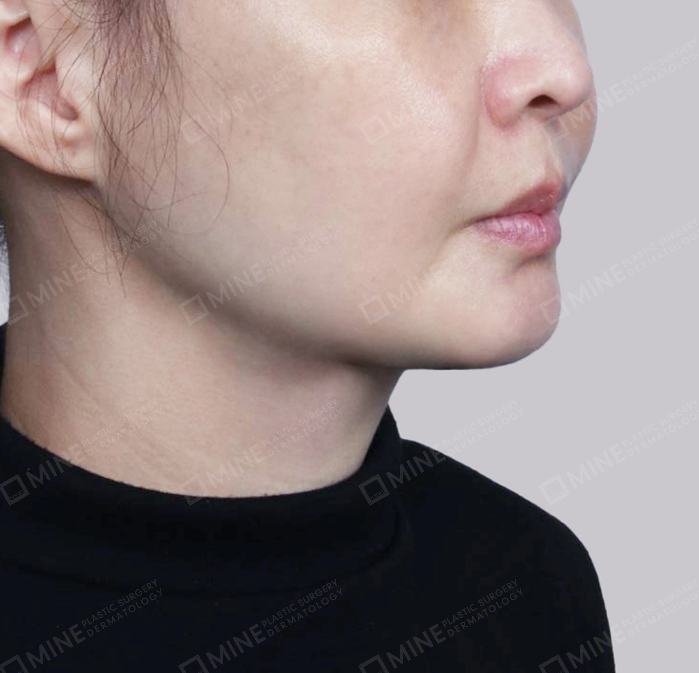 คางสองชั้น + การกำจัดต่อมน้ำลายใต้คาง-정면-후