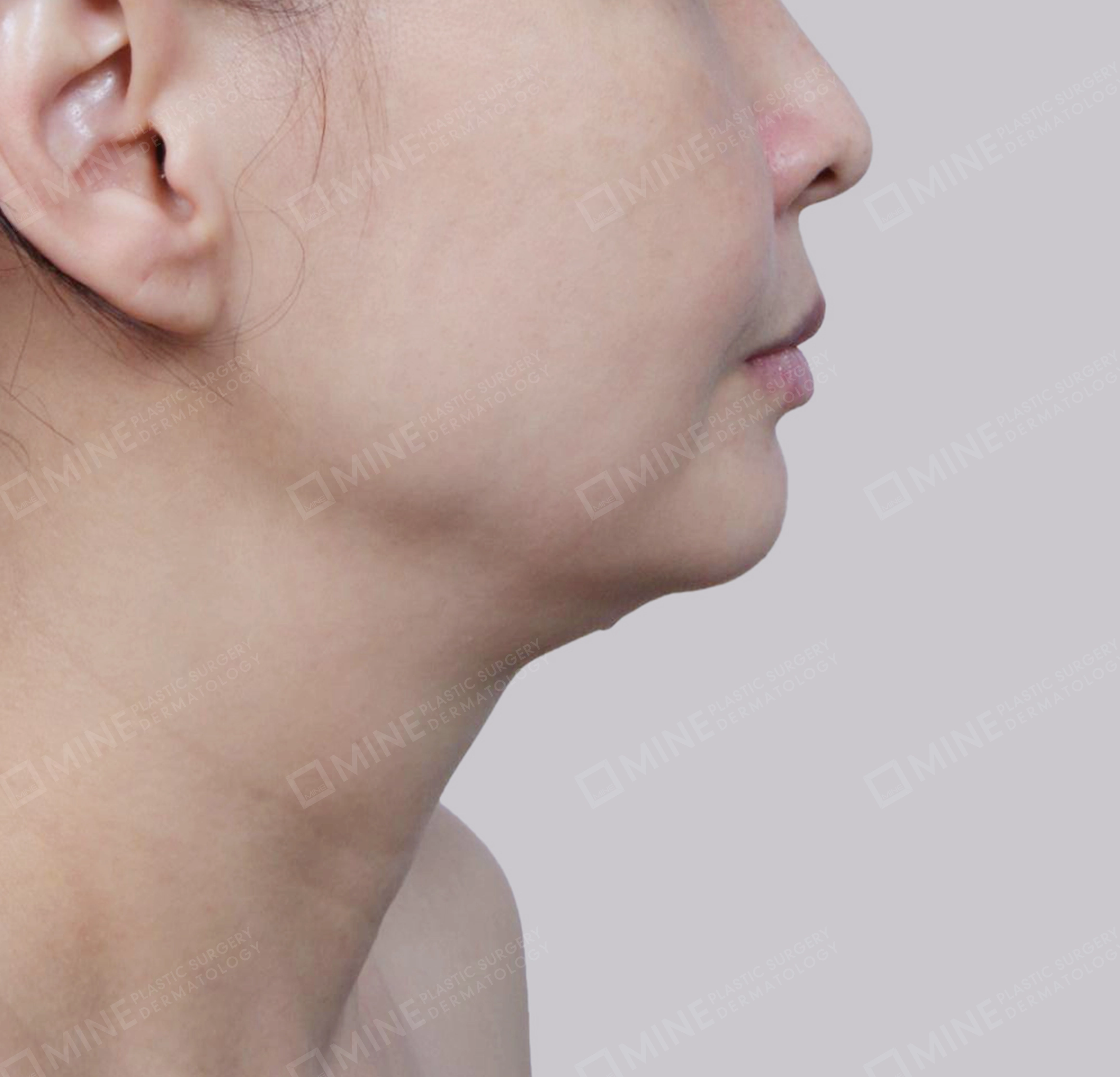 คางสองชั้น + การกำจัดต่อมน้ำลายใต้คาง-측면-전