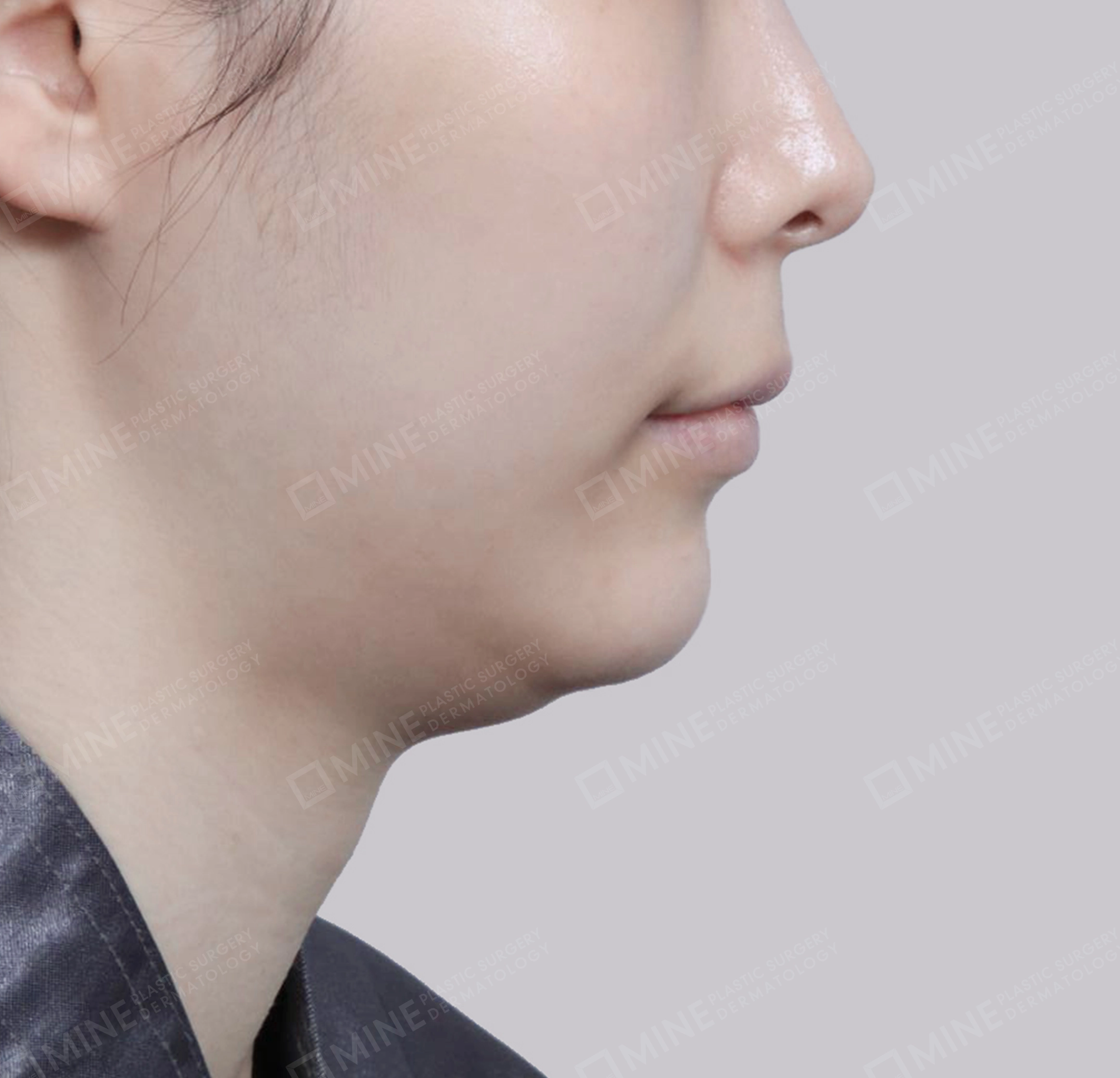 คางสองชั้น + การกำจัดต่อมน้ำลายใต้คาง-측면-전