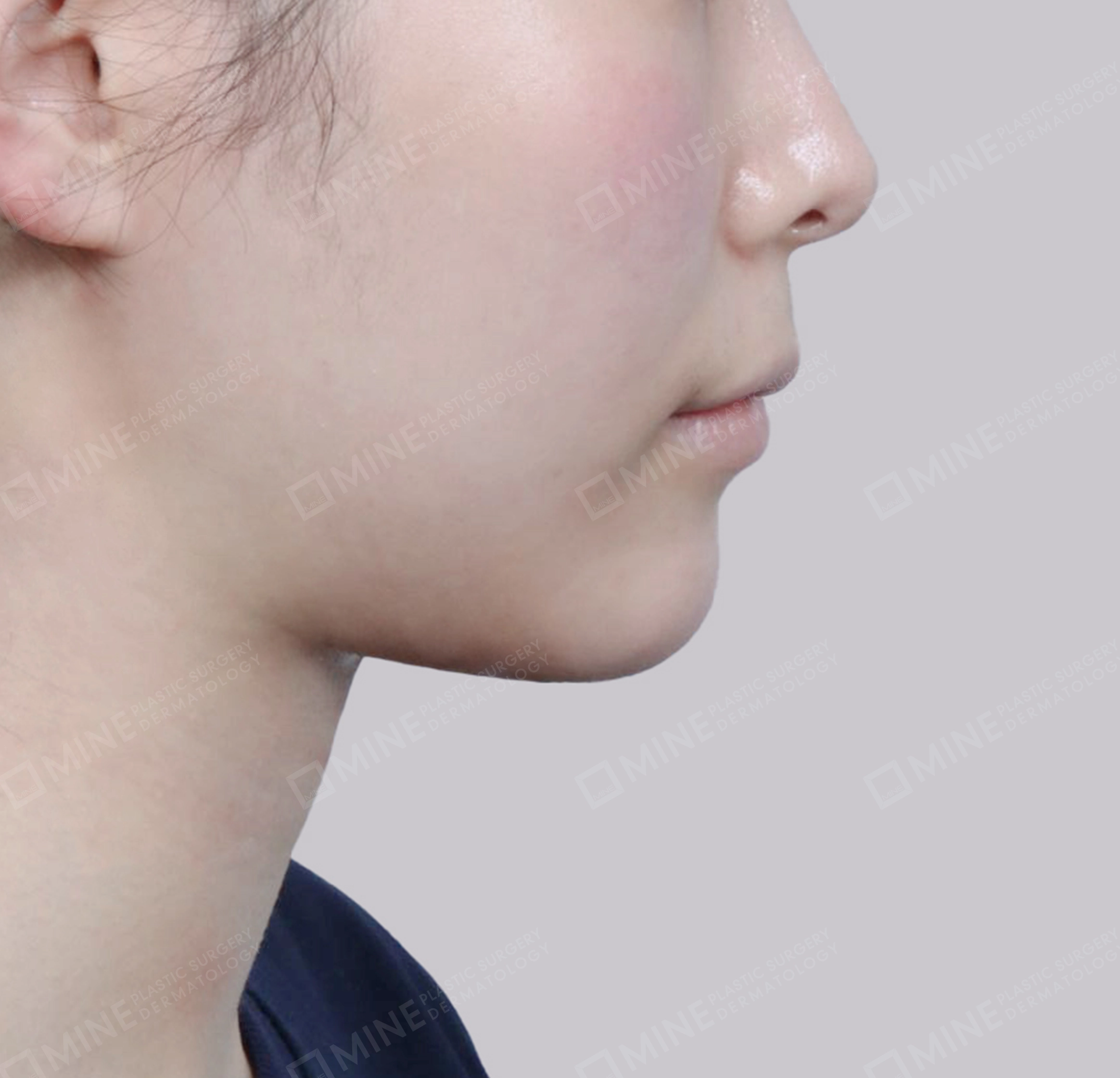 คางสองชั้น + การกำจัดต่อมน้ำลายใต้คาง-측면-후