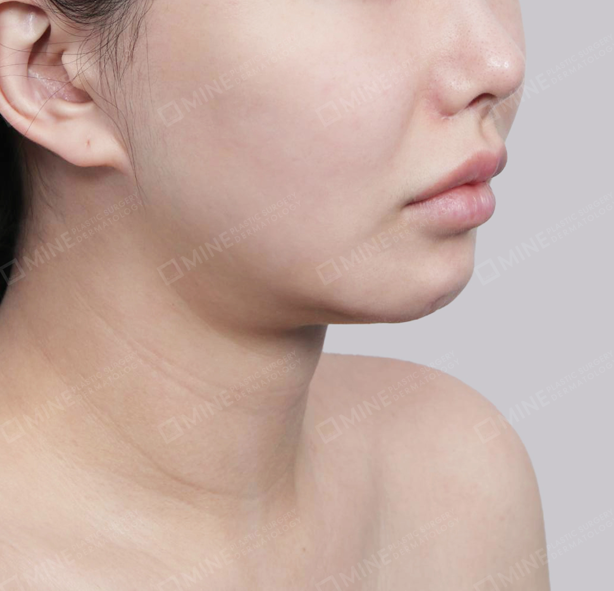 คางสองชั้น + การกำจัดต่อมน้ำลายใต้คาง-정면-전