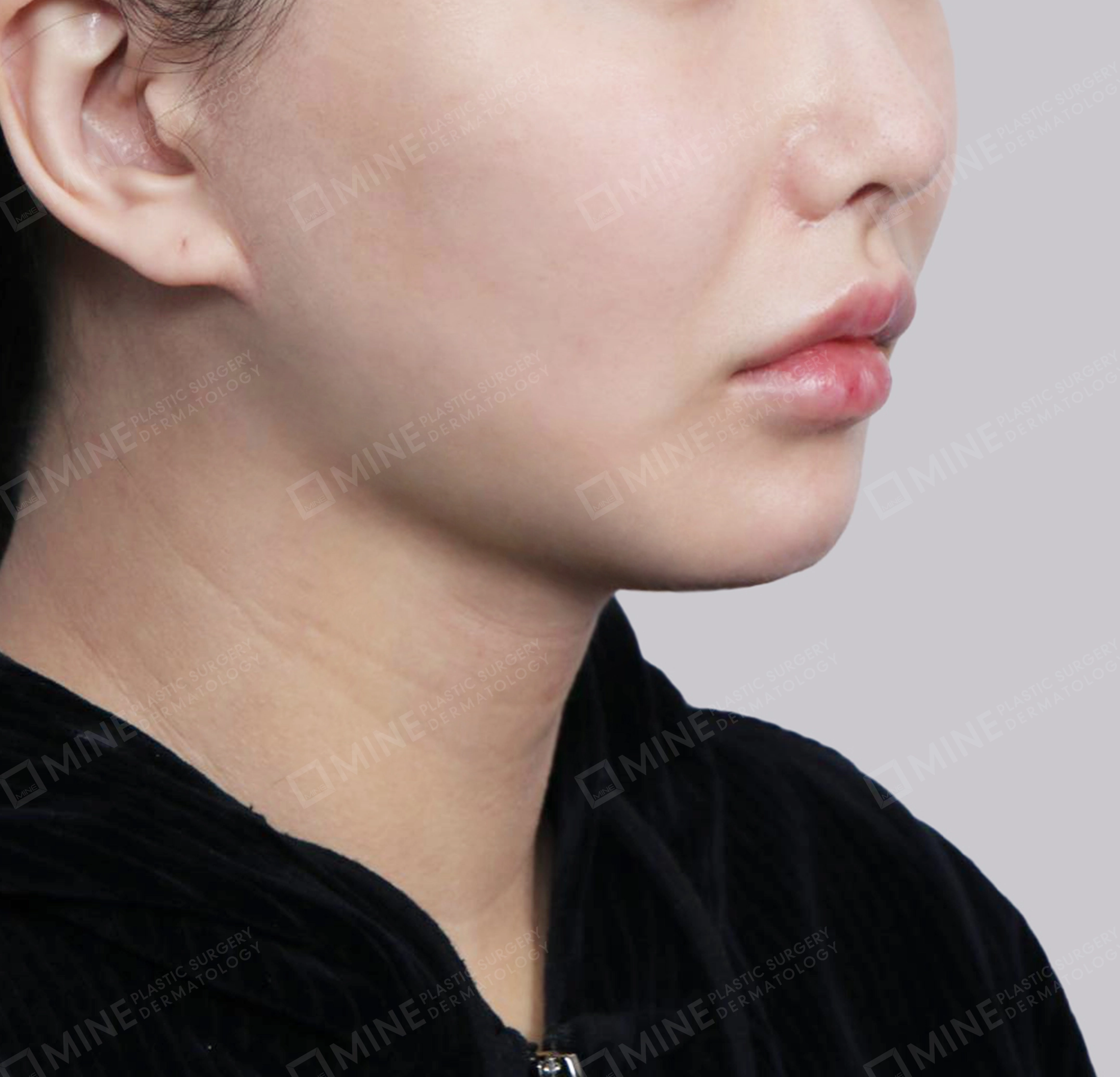 คางสองชั้น + การกำจัดต่อมน้ำลายใต้คาง-정면-후