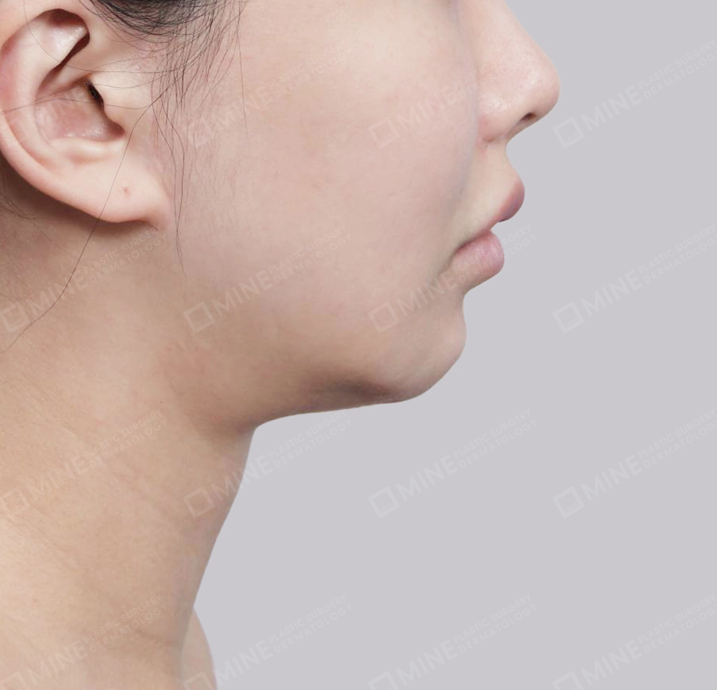 คางสองชั้น + การกำจัดต่อมน้ำลายใต้คาง-측면-전