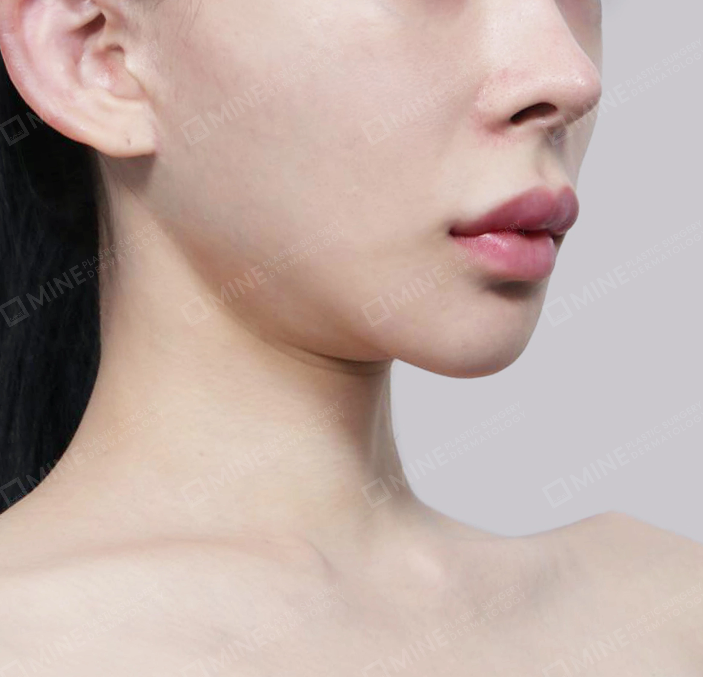 คางสองชั้น + การกำจัดต่อมน้ำลายใต้คาง-정면-전