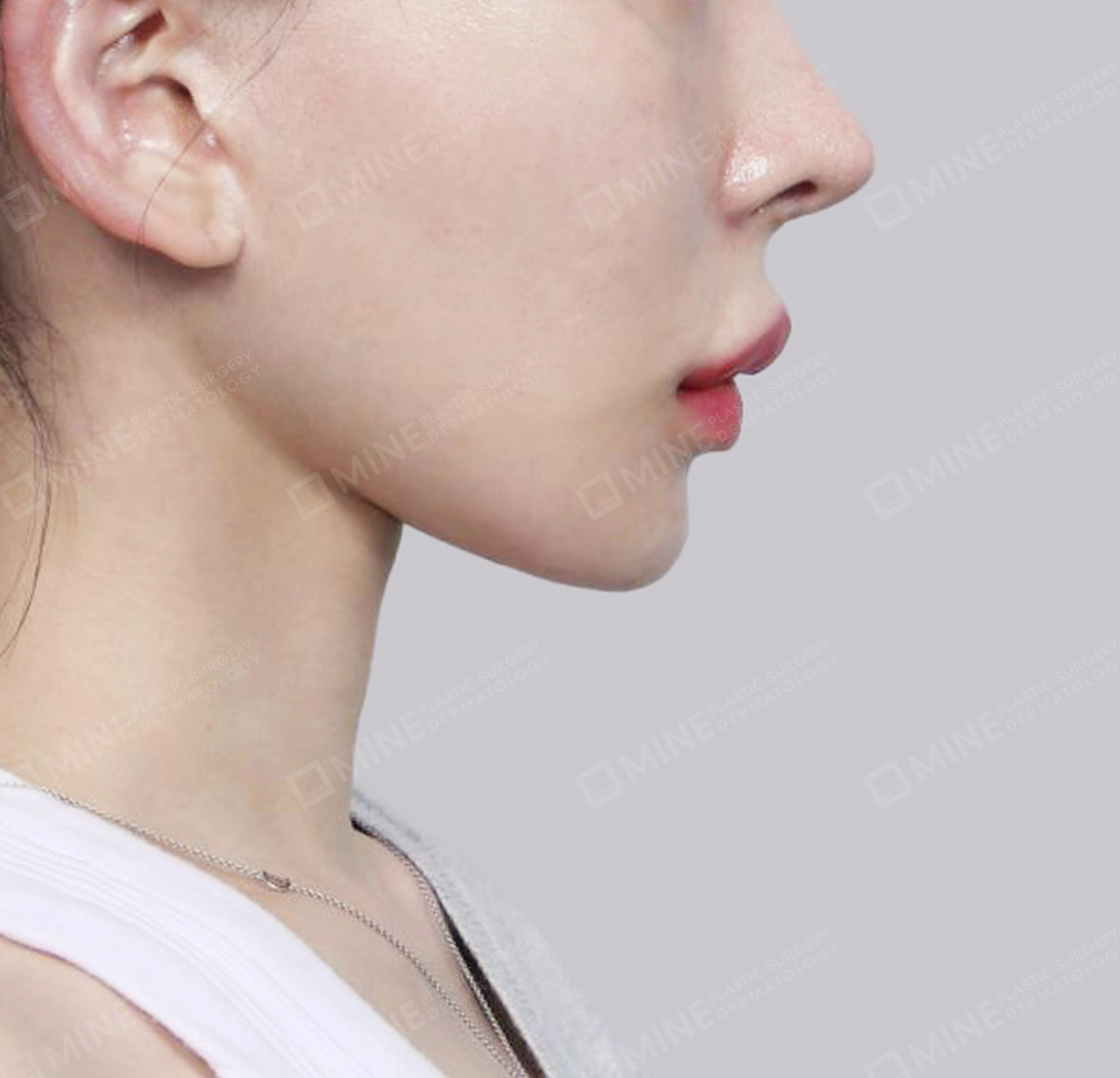 คางสองชั้น + การกำจัดต่อมน้ำลายใต้คาง-측면-후