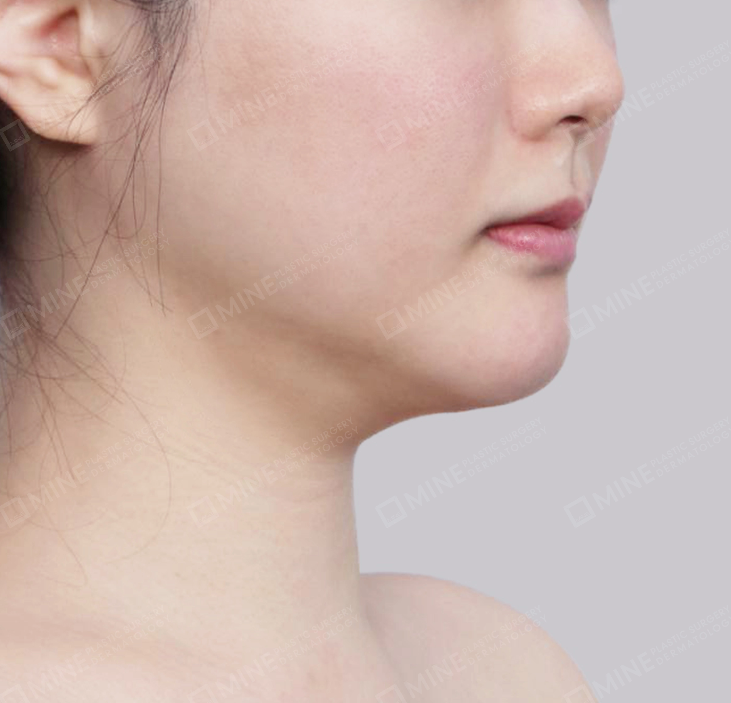 คางสองชั้น + การกำจัดต่อมน้ำลายใต้คาง-정면-전