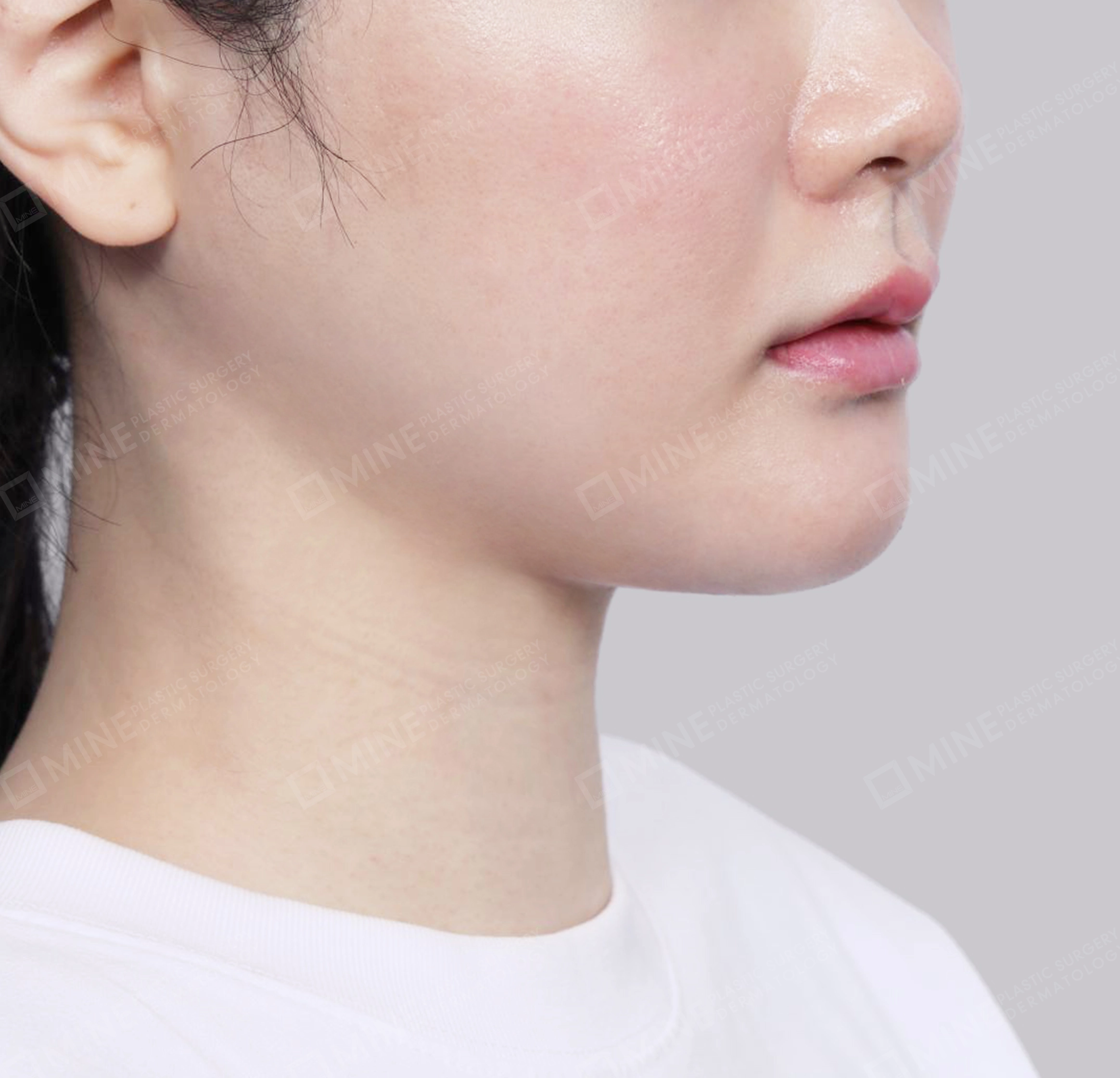 คางสองชั้น + การกำจัดต่อมน้ำลายใต้คาง-정면-후