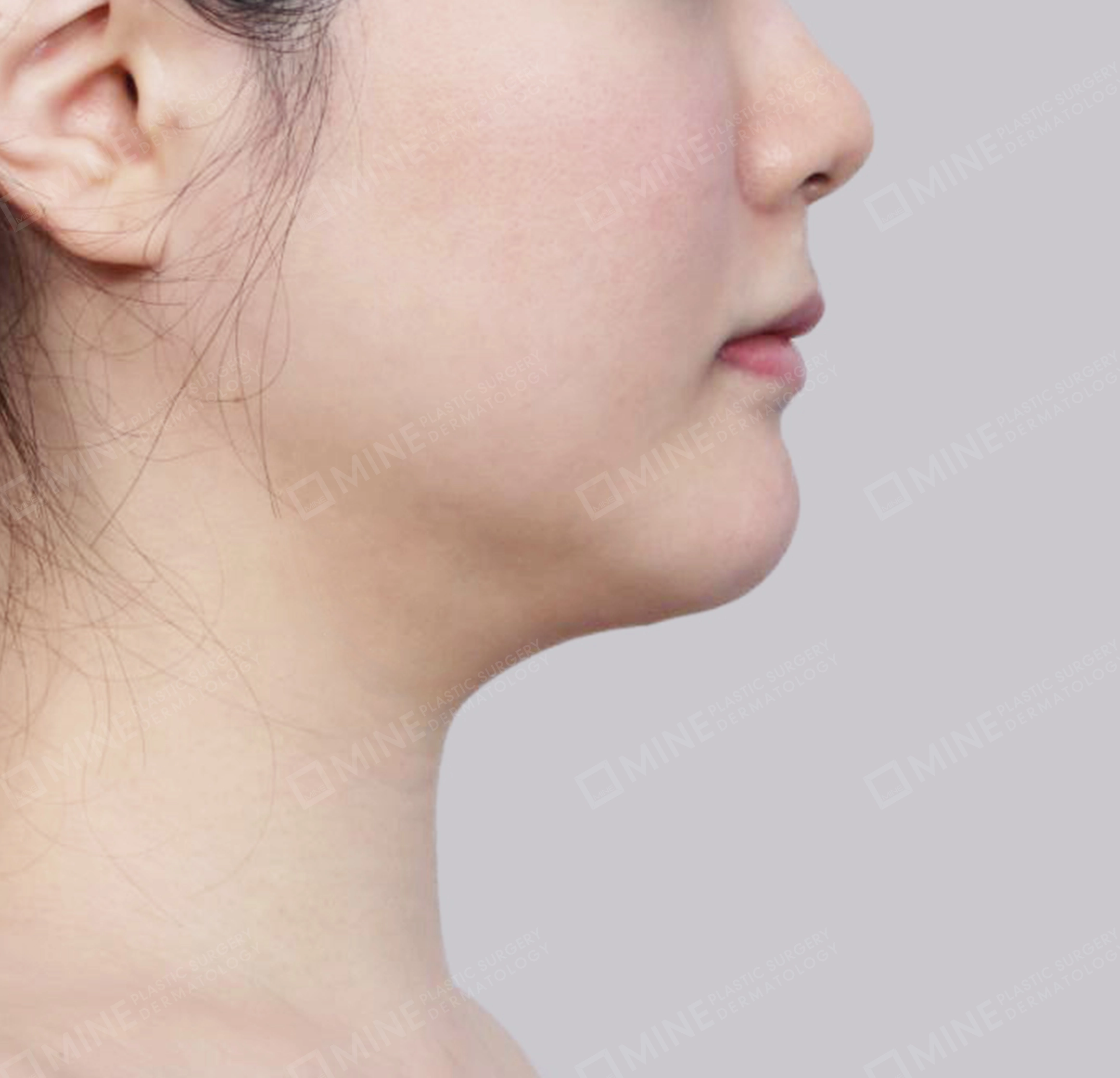 คางสองชั้น + การกำจัดต่อมน้ำลายใต้คาง-측면-전