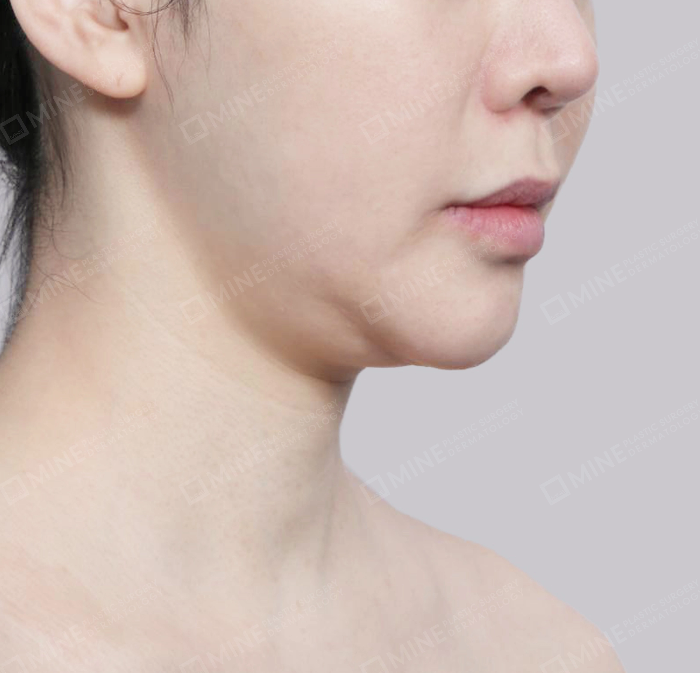 คางสองชั้น + การกำจัดต่อมน้ำลายใต้คาง-정면-전