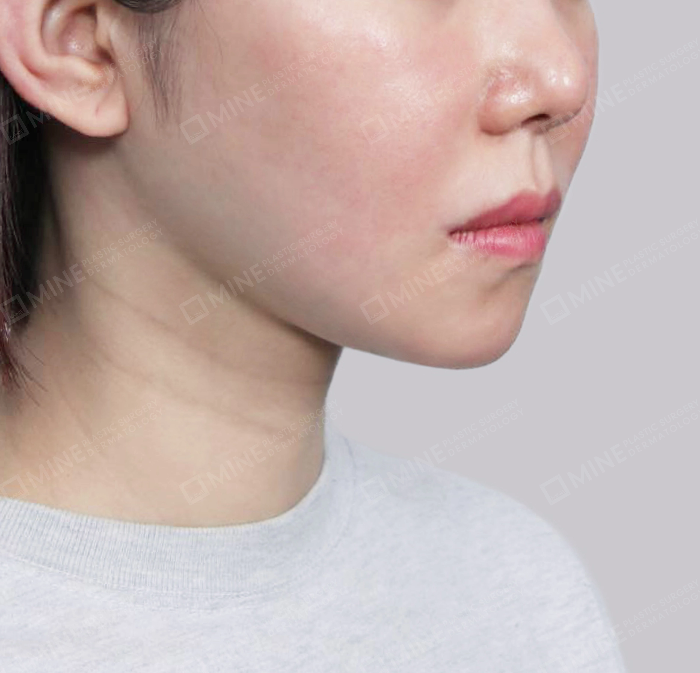 คางสองชั้น + การกำจัดต่อมน้ำลายใต้คาง-정면-후