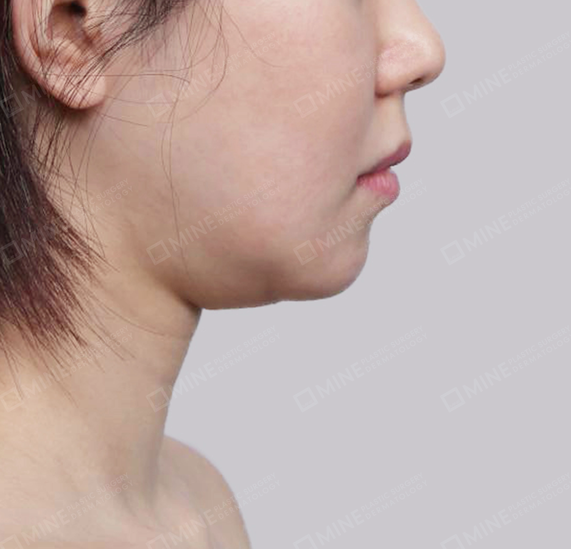 คางสองชั้น + การกำจัดต่อมน้ำลายใต้คาง-측면-전