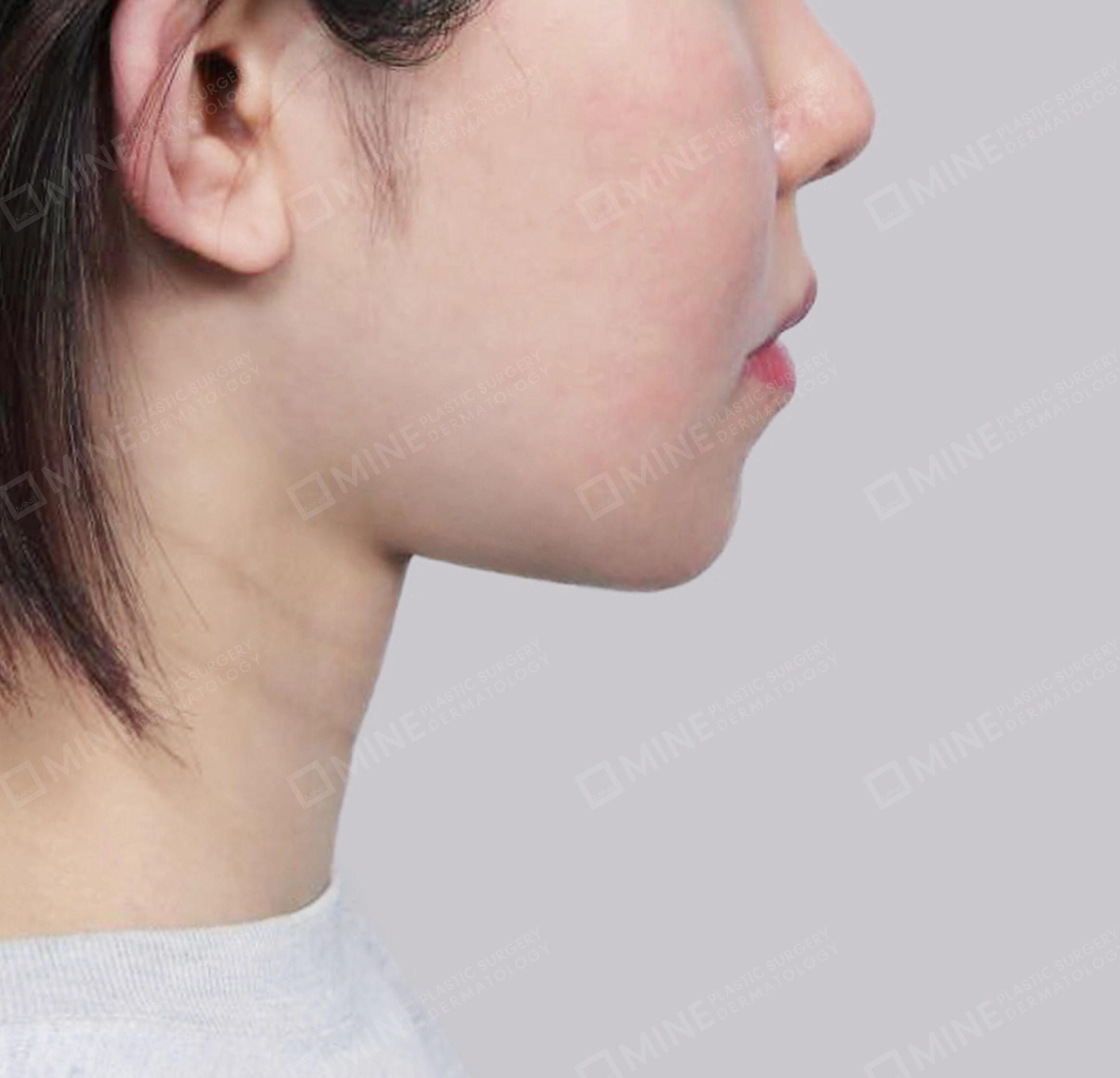 คางสองชั้น + การกำจัดต่อมน้ำลายใต้คาง-측면-후