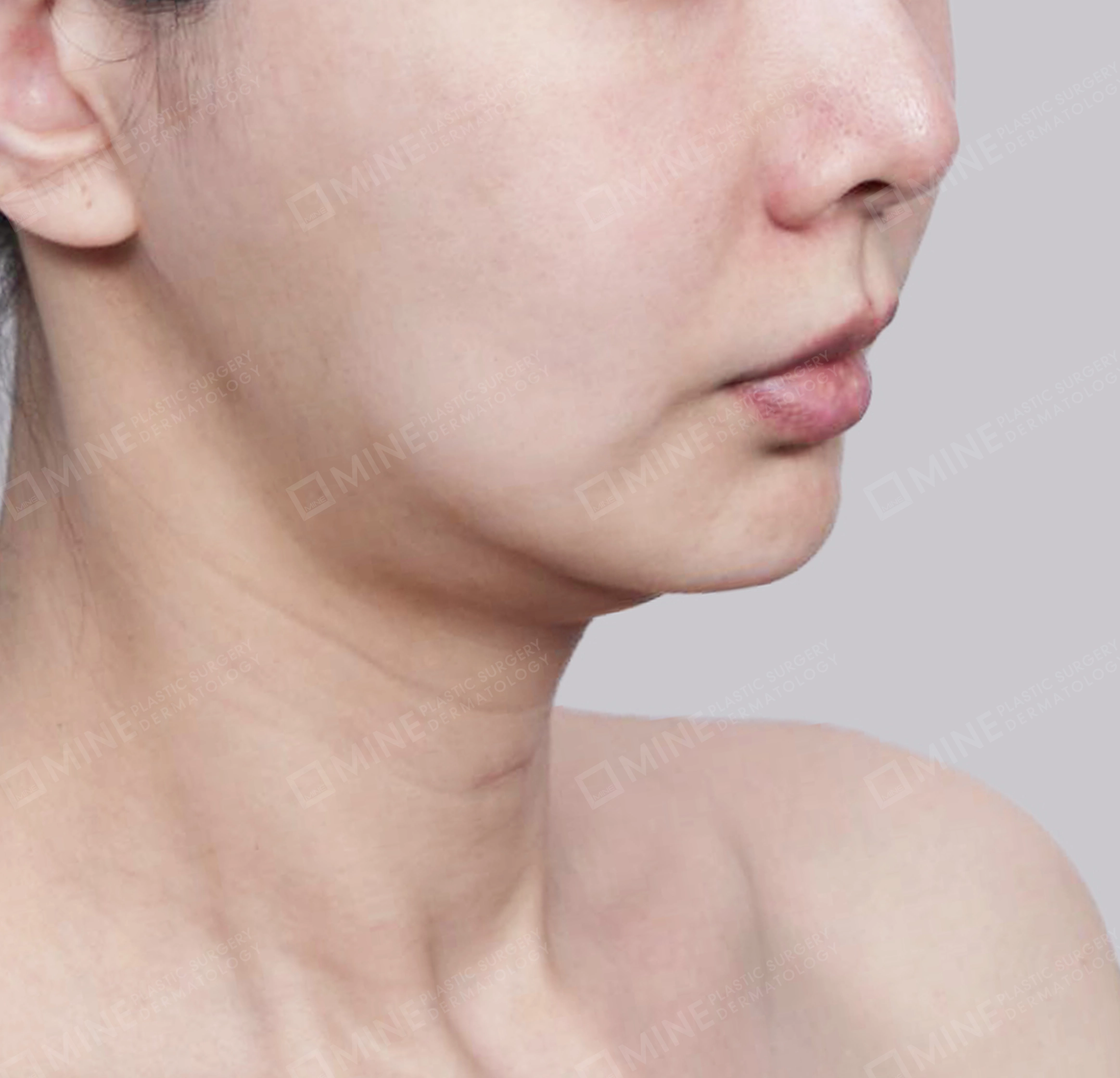 คางสองชั้น + การกำจัดต่อมน้ำลายใต้คาง-정면-전