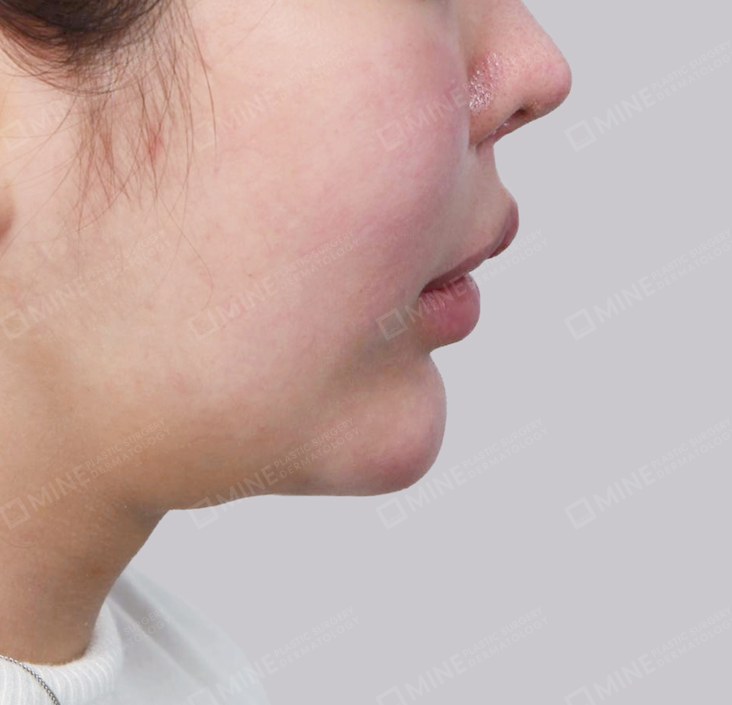 คางสองชั้น + การกำจัดต่อมน้ำลายใต้คาง-측면-전