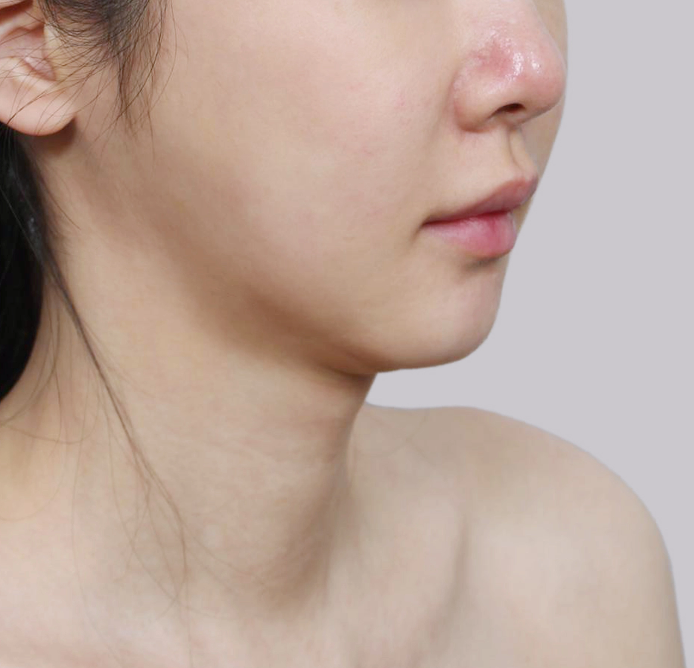 ยกกระชับแบบมินิ-45 องศา-ก่อน