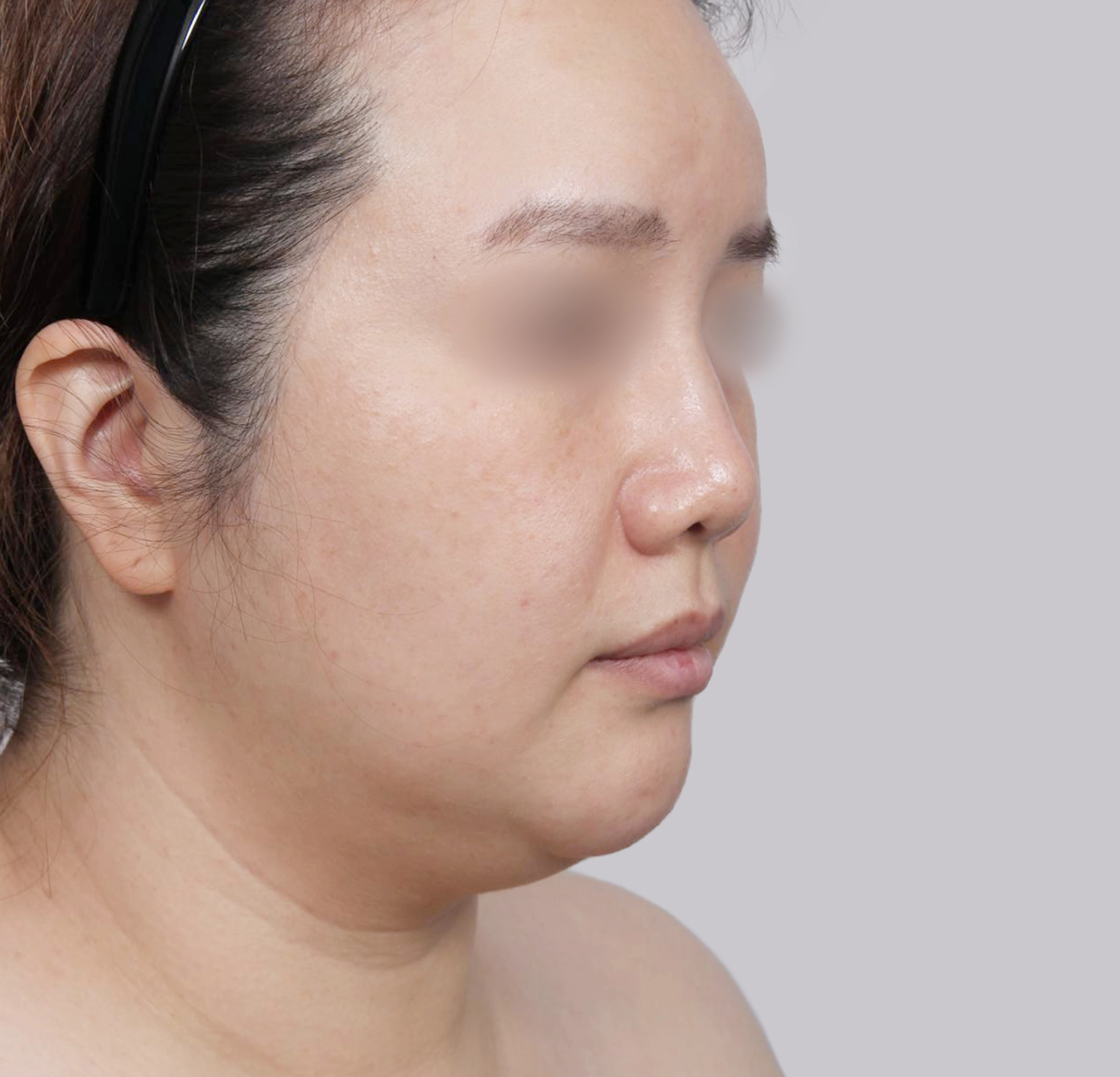 ยกกระชับแบบมินิ-45 องศา-ก่อน